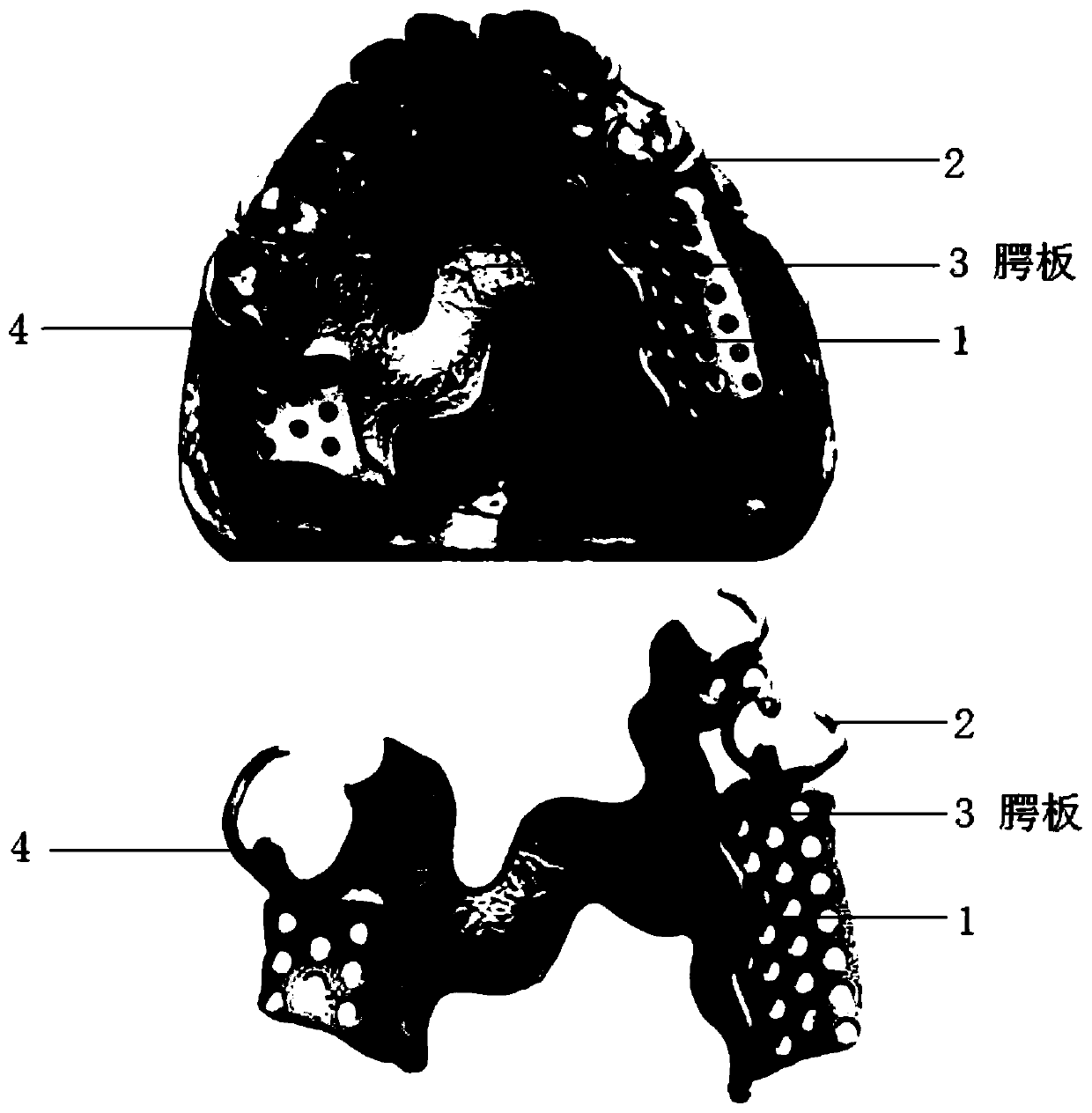 Personalized removable local dentures holder, and design method and manufacture method thereof