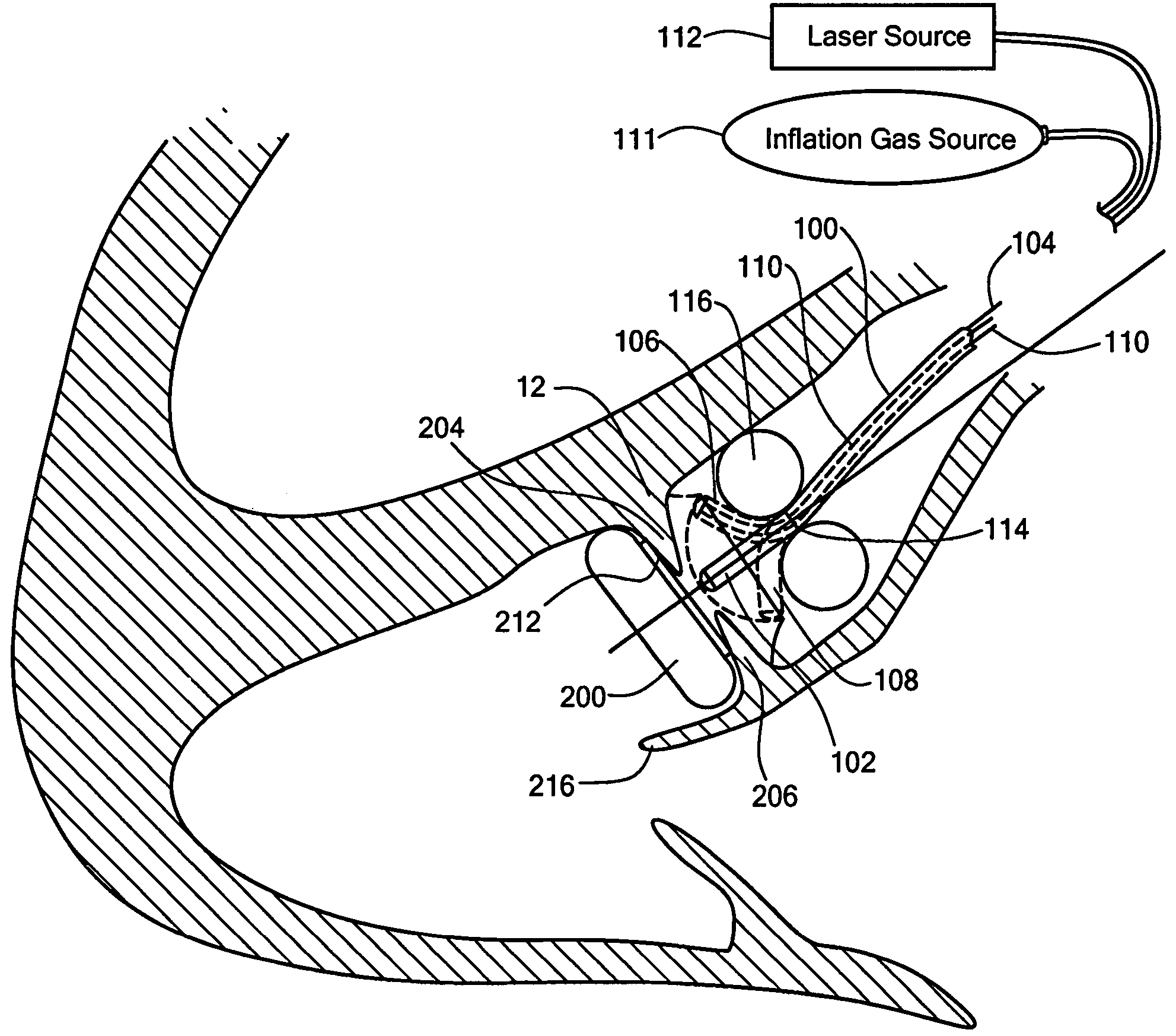 Endovascular tissue removal device