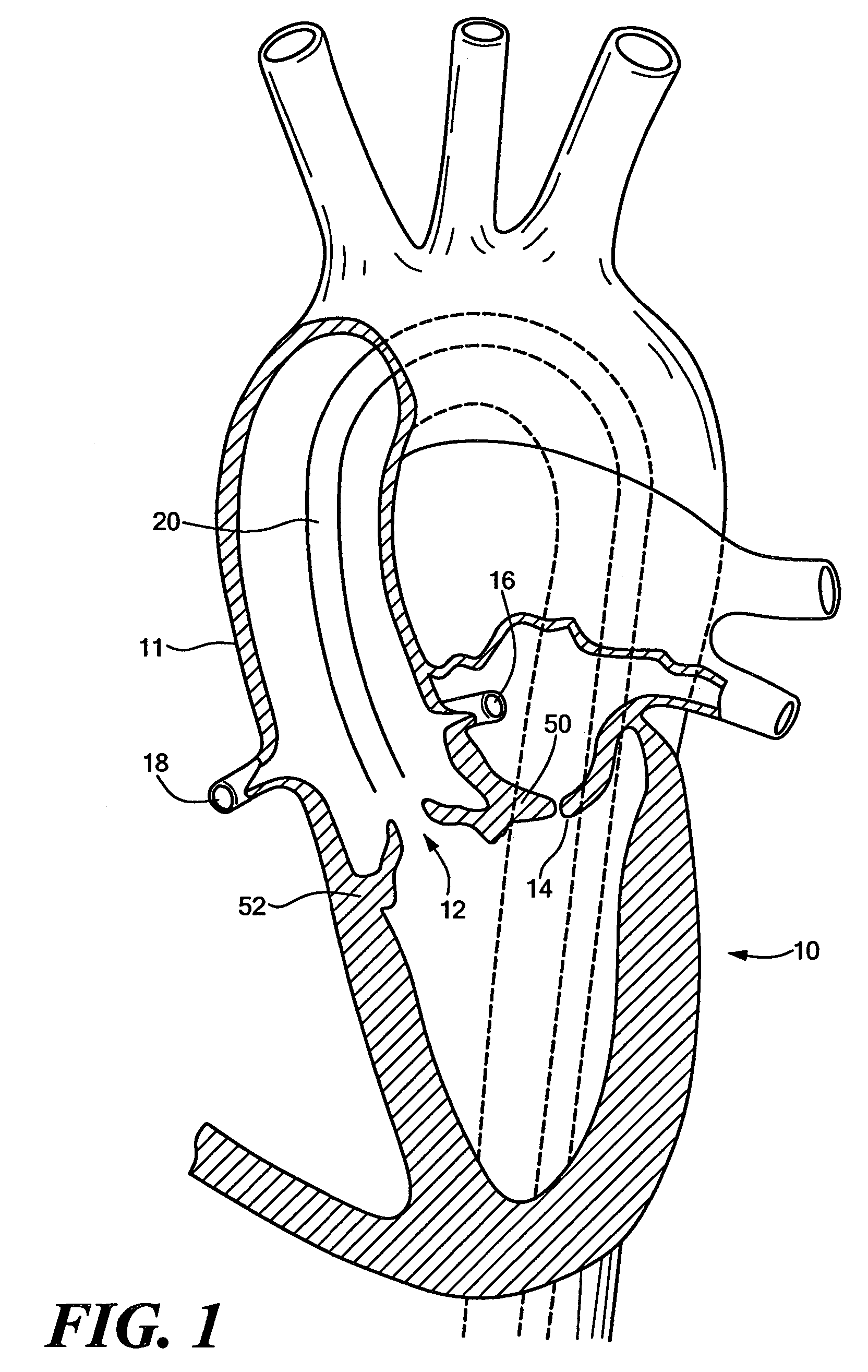 Endovascular tissue removal device