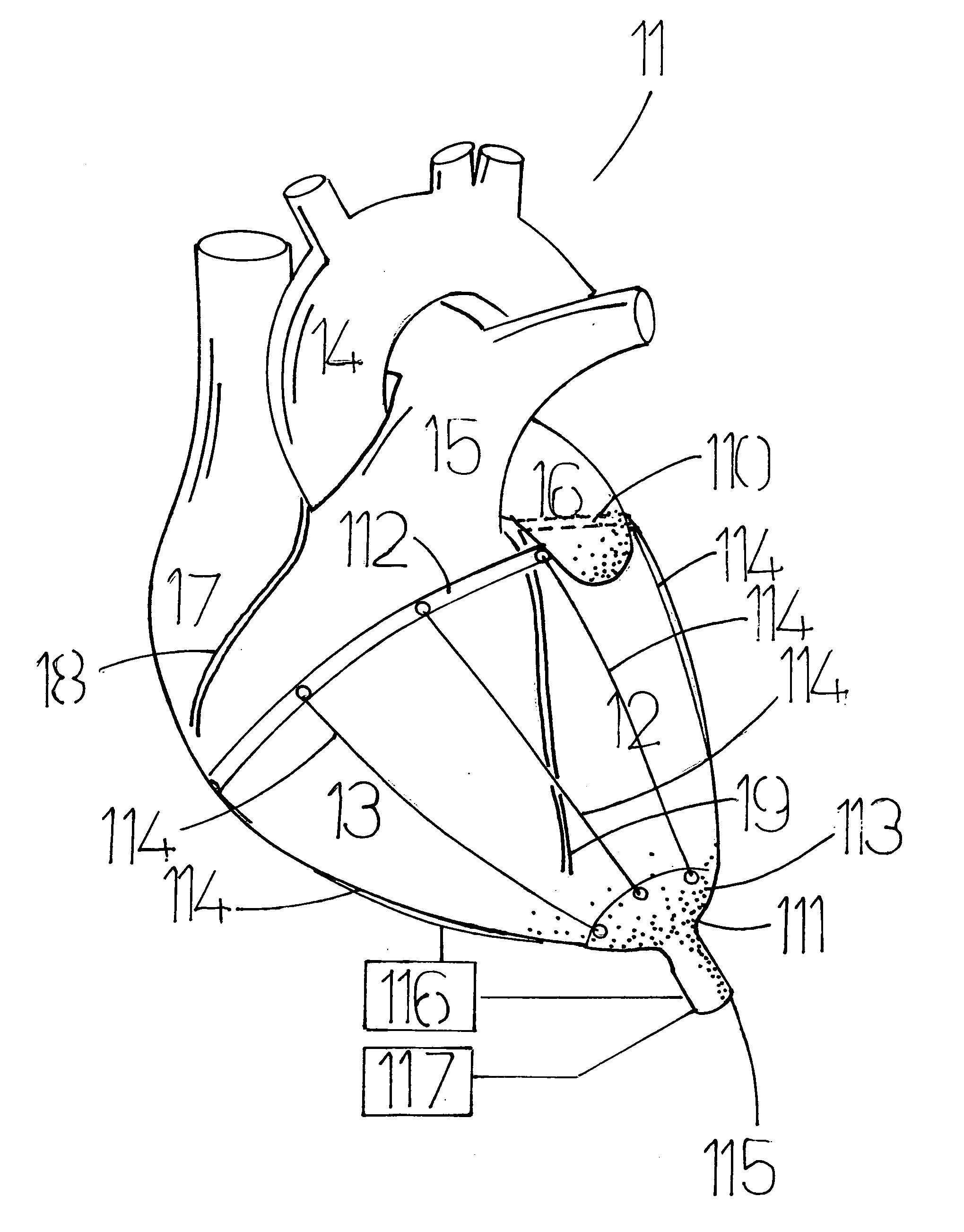 Non-blood contact cardiac compression device, for augmentation of cardiac function by timed cyclic tensioning of elastic cords in an epicardial location