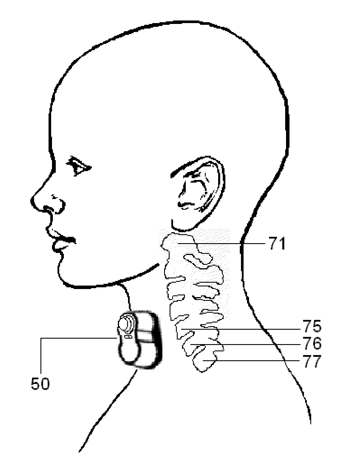 Electrical and magnetic stimulators used to treat migraine/sinus headache, rhinitis, sinusitis, rhinosinusitis, and comorbid disorders