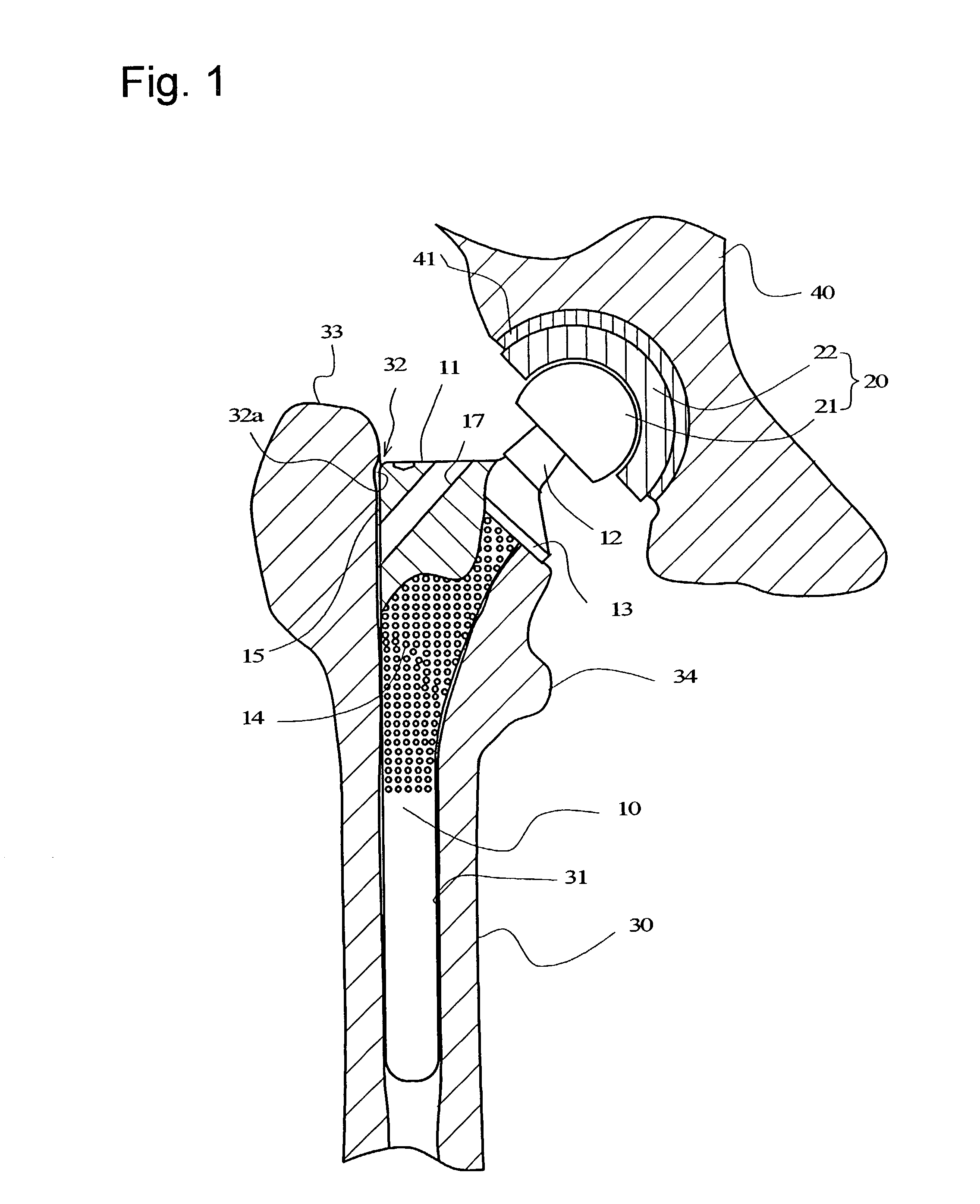 Stem of artificial hip joint