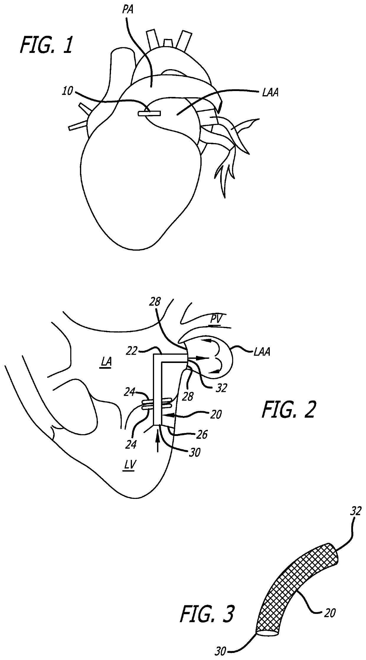 Left atrial appendage stasis reduction