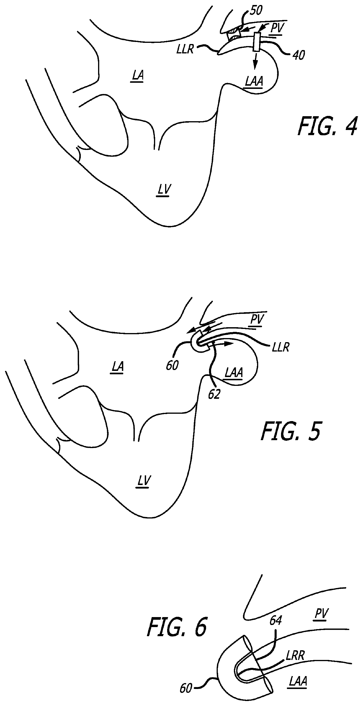 Left atrial appendage stasis reduction