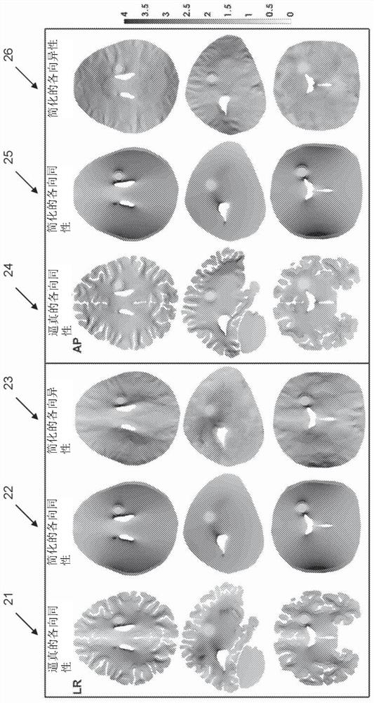 TTFIELD treatments with electrode position optimization on head based on MRI-based conductivity measurements