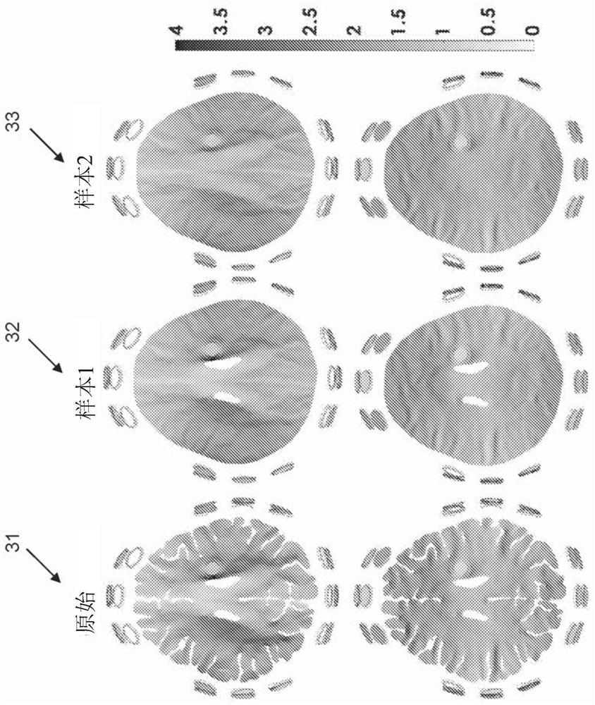 TTFIELD treatments with electrode position optimization on head based on MRI-based conductivity measurements