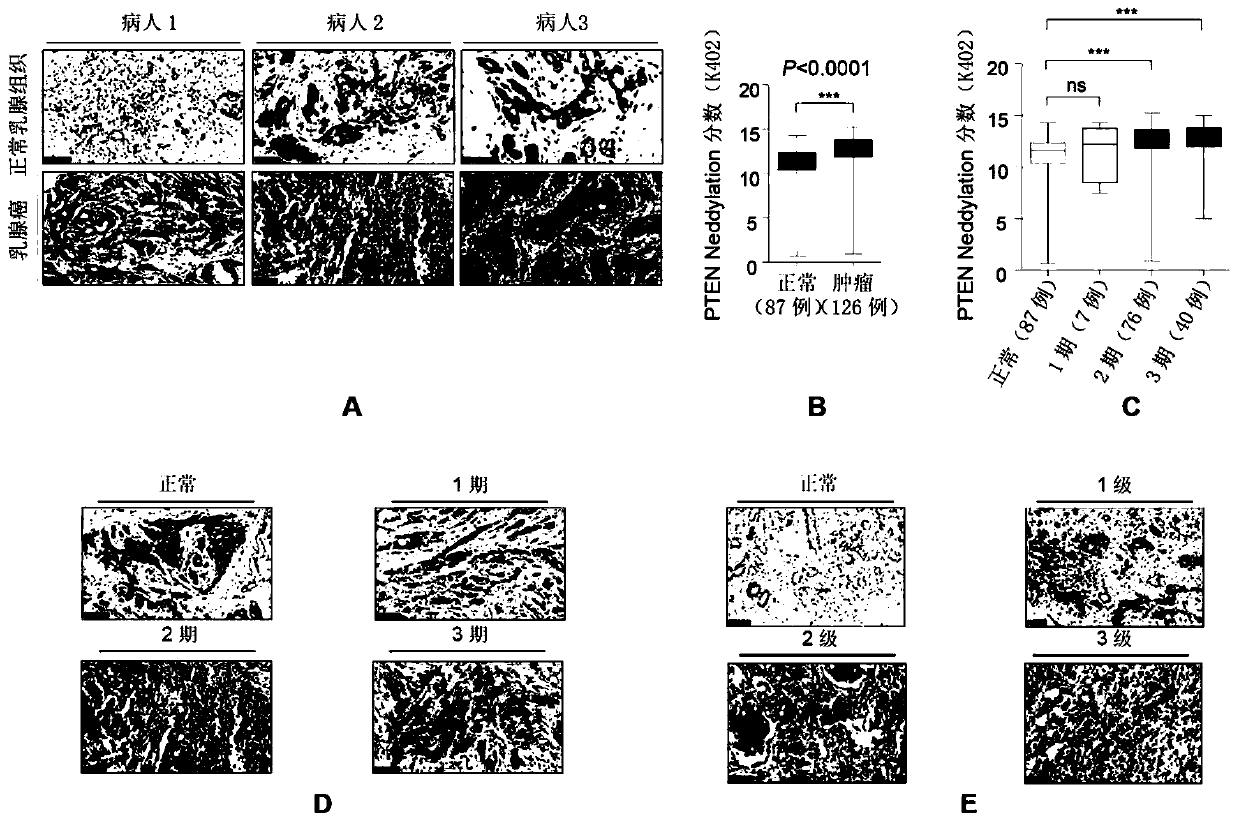 Invention and application of PTEN Nedd8 modification as new marker for breast cancer and specific antibody of modification