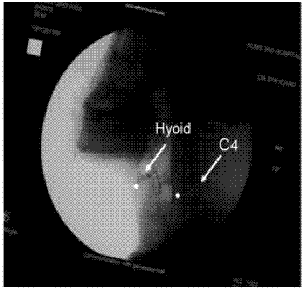 Medical swallowing image collection device and image processing method thereof