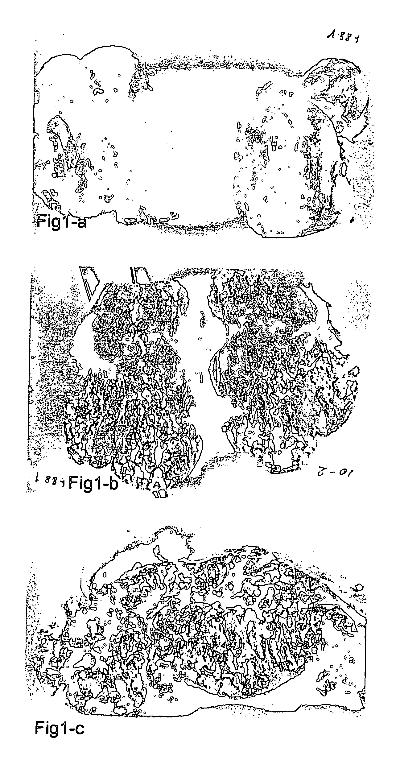 Method of cancer therapy by in situ production of F5 antibodies