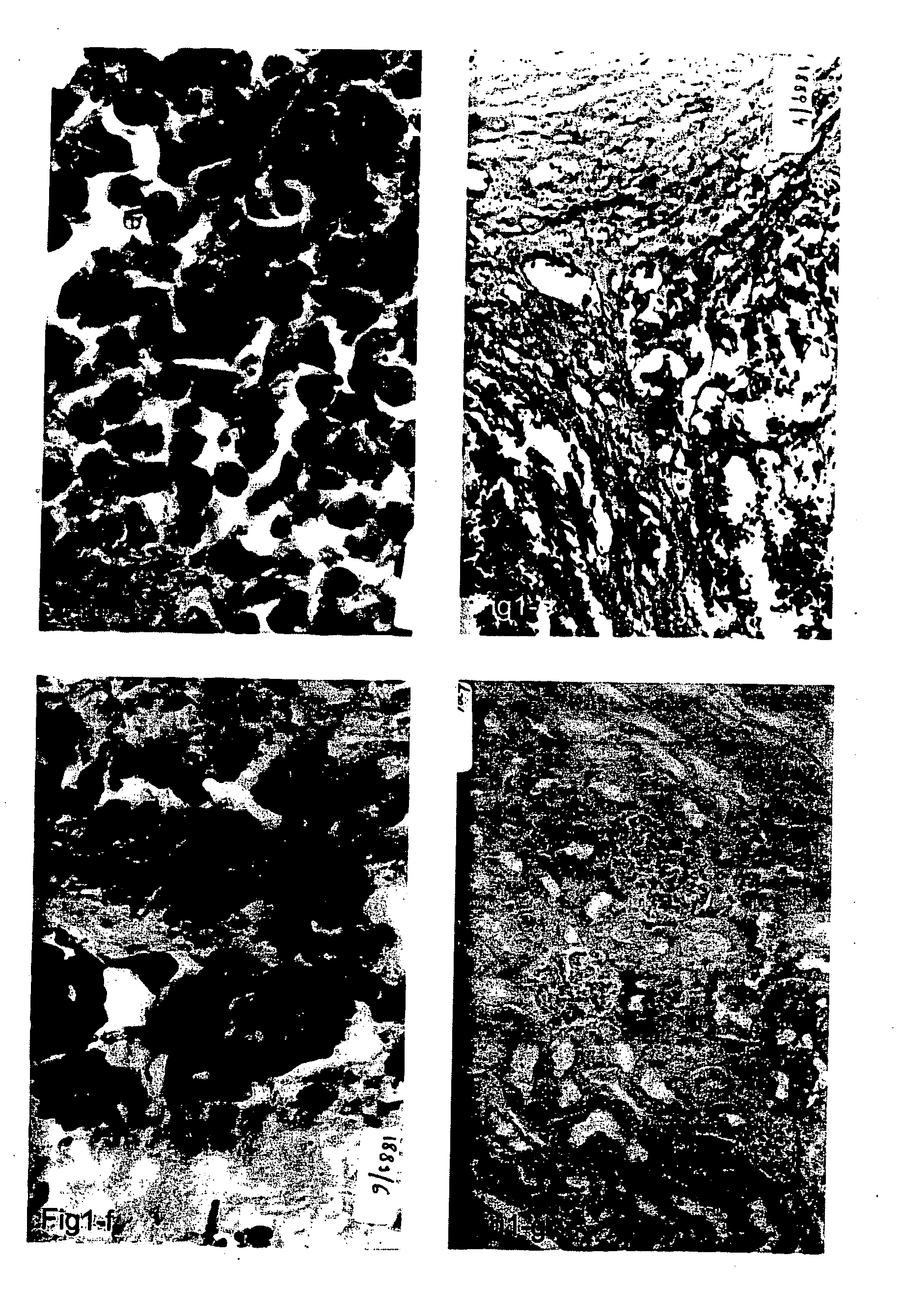 Method of cancer therapy by in situ production of F5 antibodies