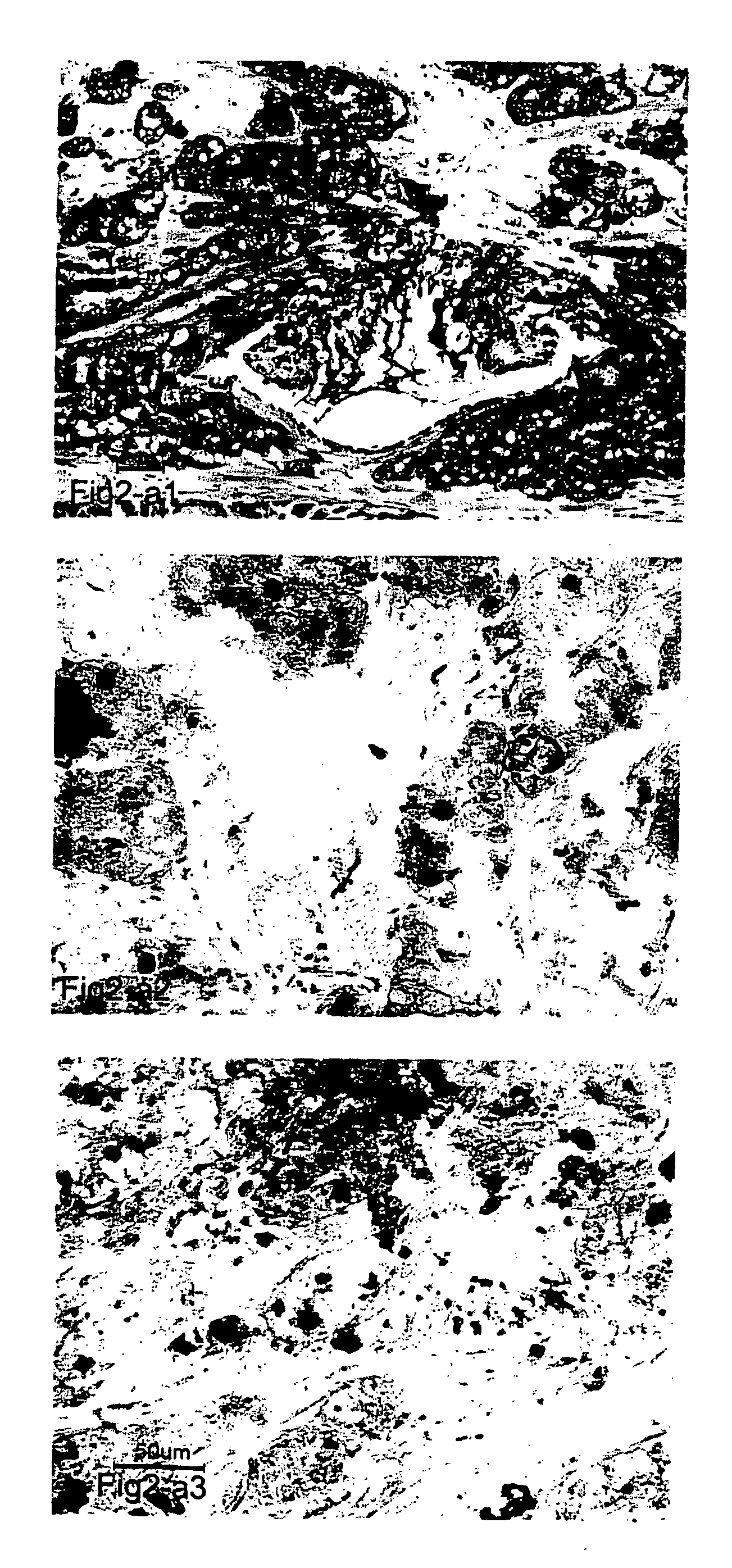 Method of cancer therapy by in situ production of F5 antibodies