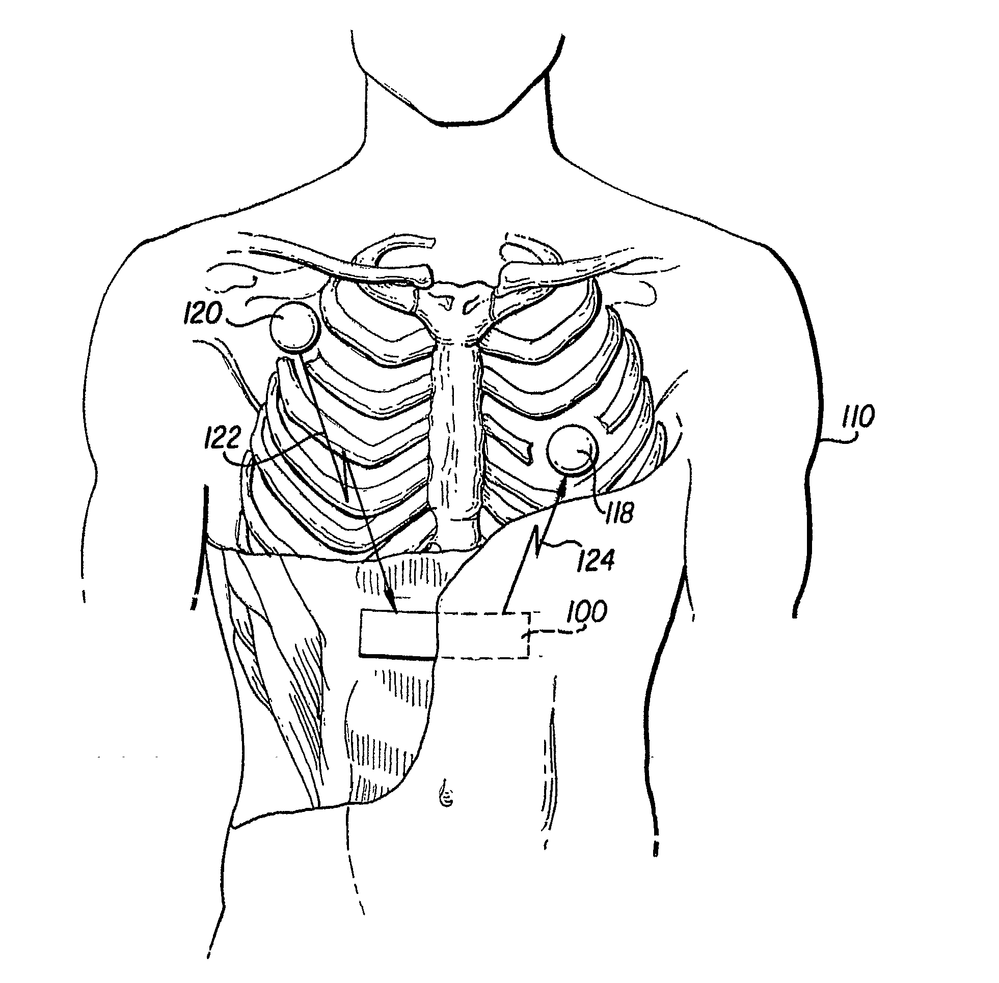 Leadless Implantable Cardioverter Defibrillator