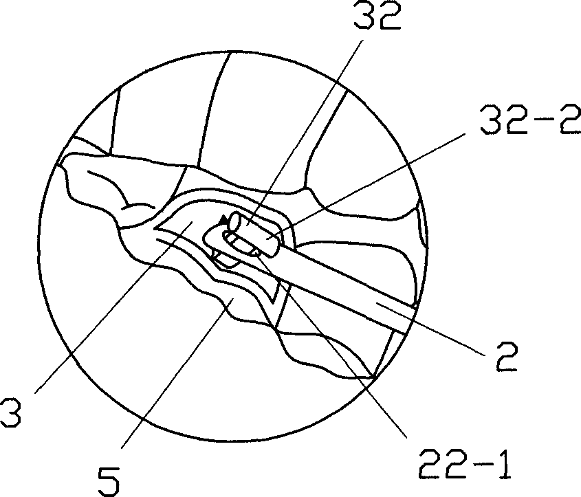 Elastic tongue dorsum traction apparatus and method for implanting same