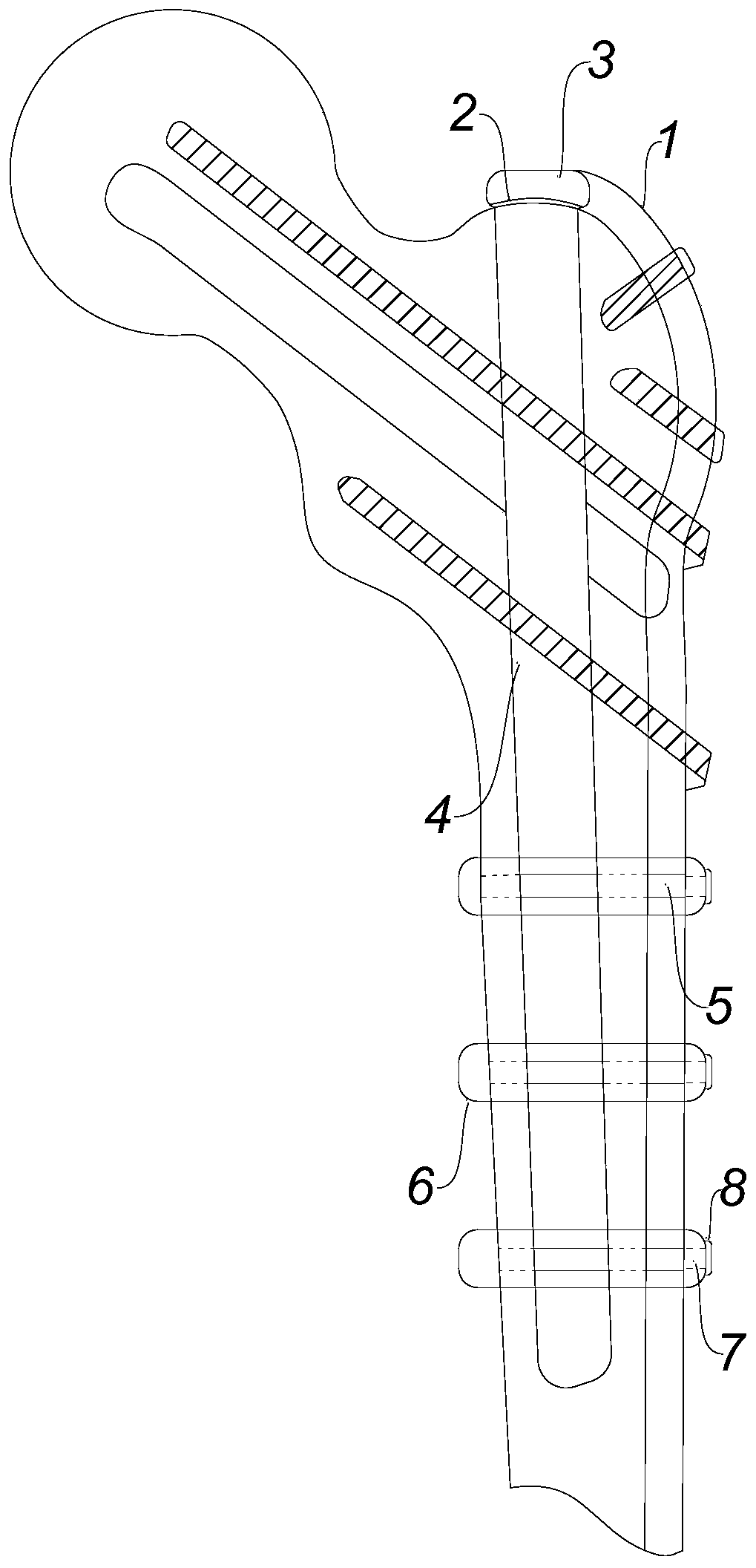 Minimally invasive treatment proximal femur comminuted fracture inside and outside marrow united fixing system