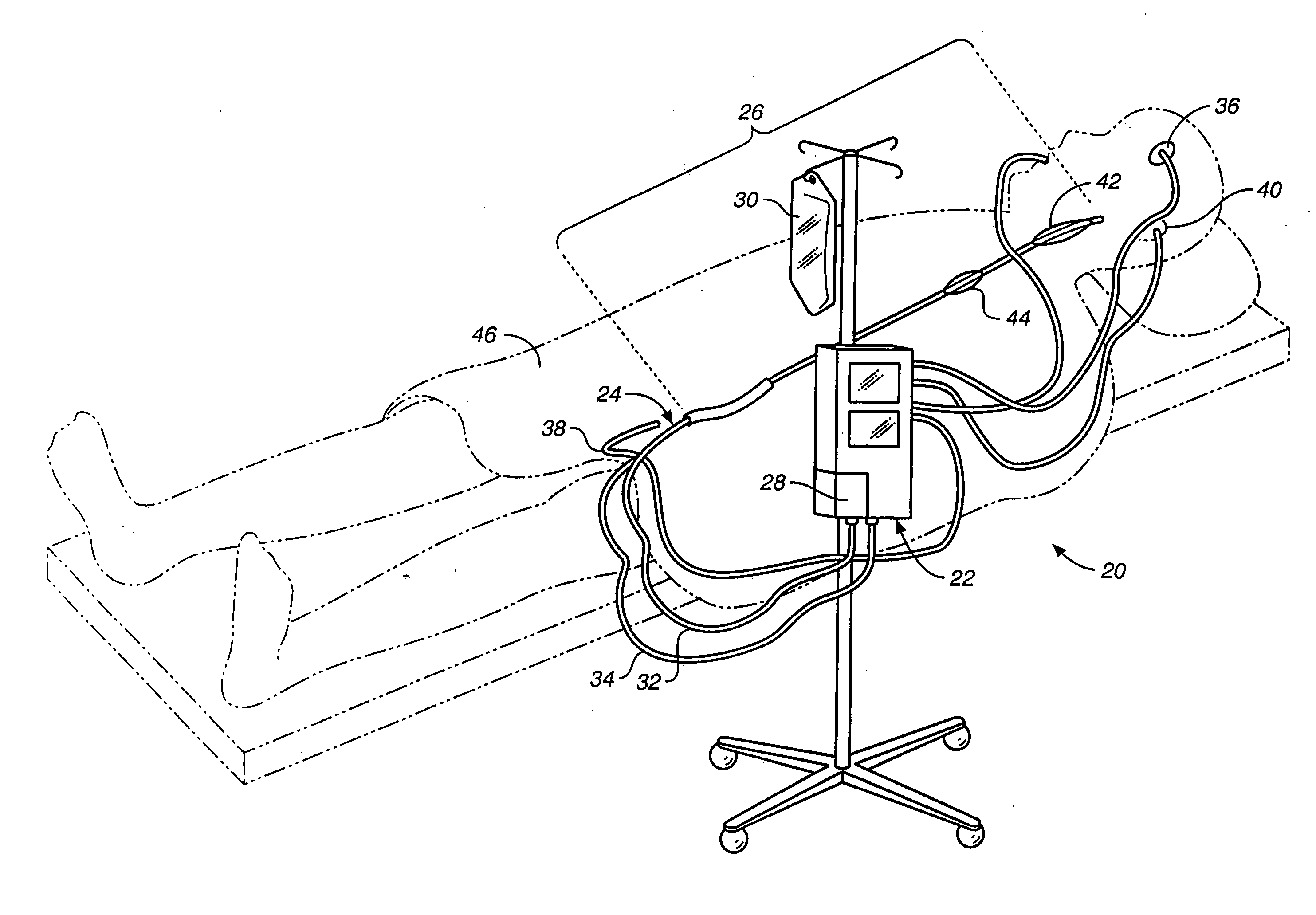 Method and system for control of a patient's body temperature by way of a transluminally insertable heat exchange catheter