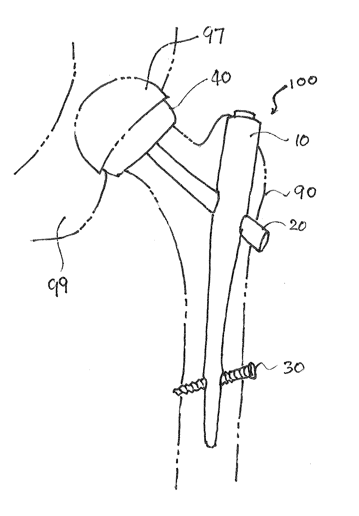 Minimal Invasive Hip Arthroplasty Device