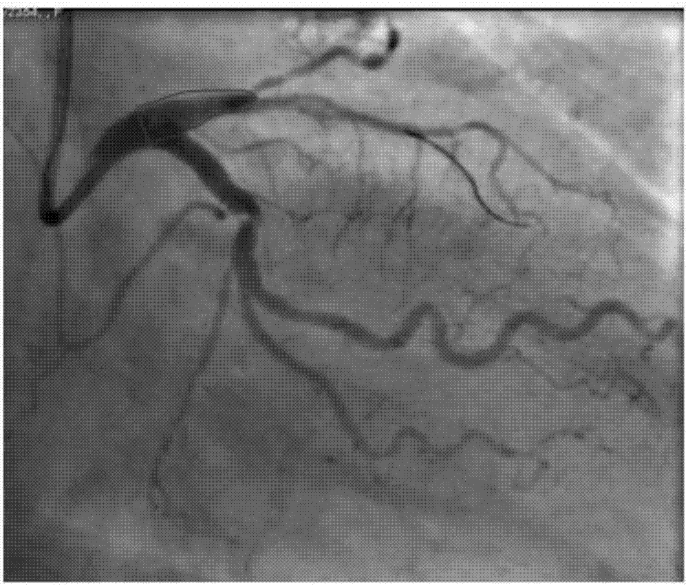 A degradable personalized non-cylindrical biomimetic drug-eluting coronary stent