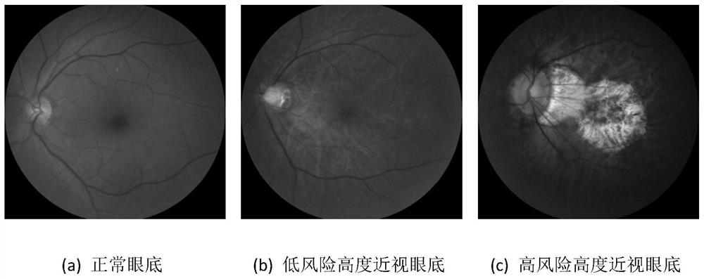 High myopia fundus lesion risk prediction method