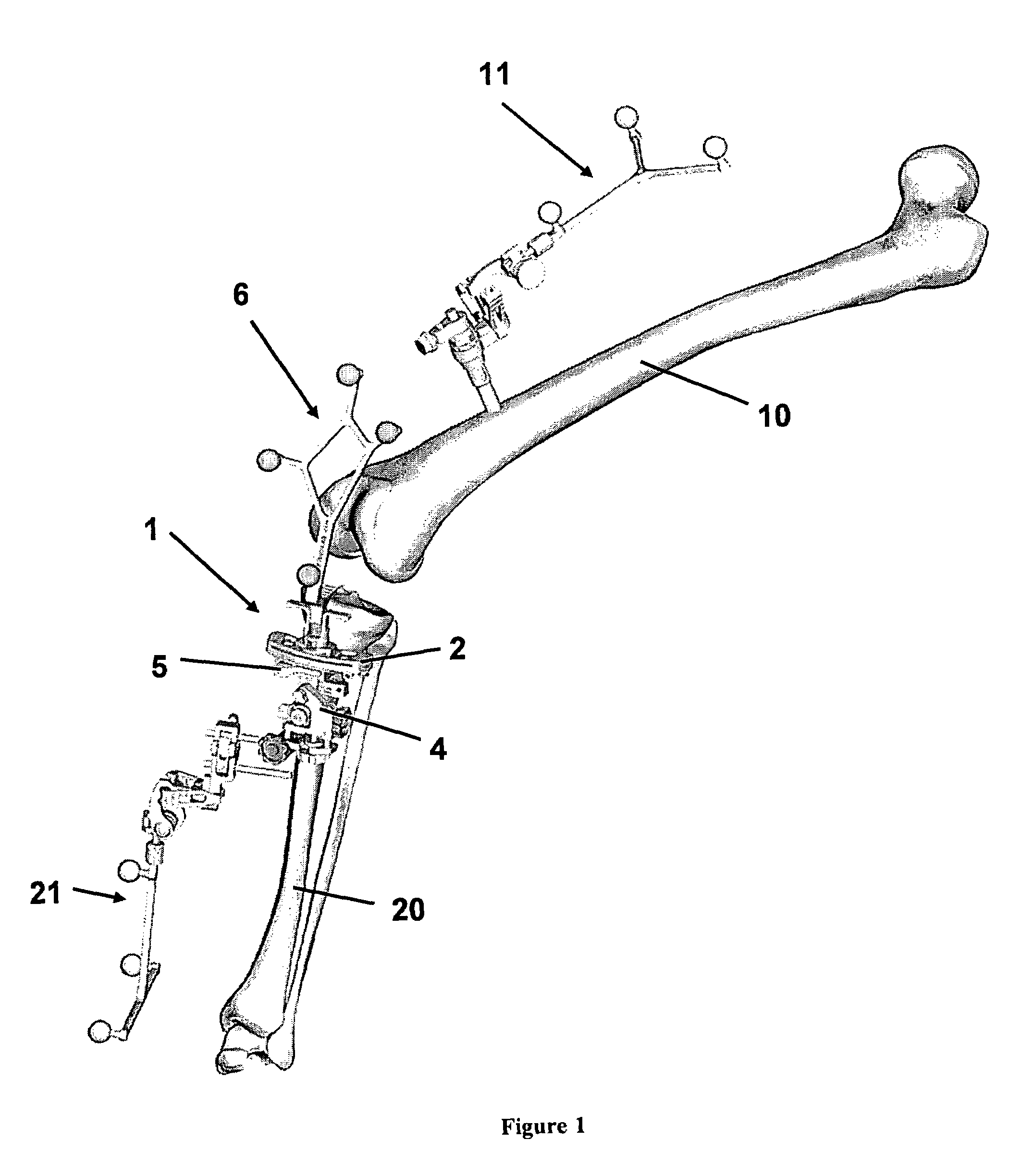 User guidance in adjusting bone incision blocks