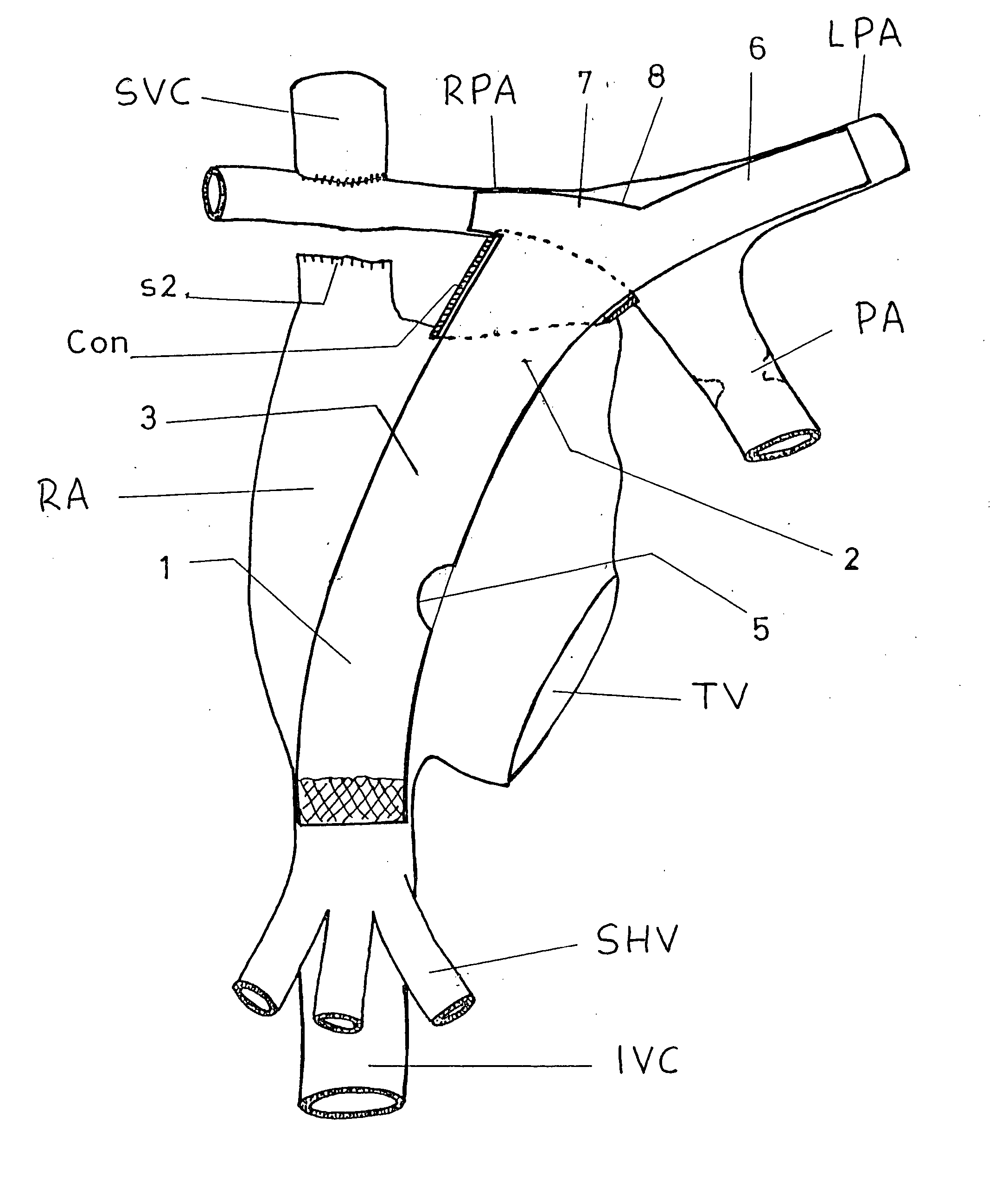 Fenestrated asymmetric intracardiac device for the completion of total cavopulmonary anastomosis through cardiac catheterization