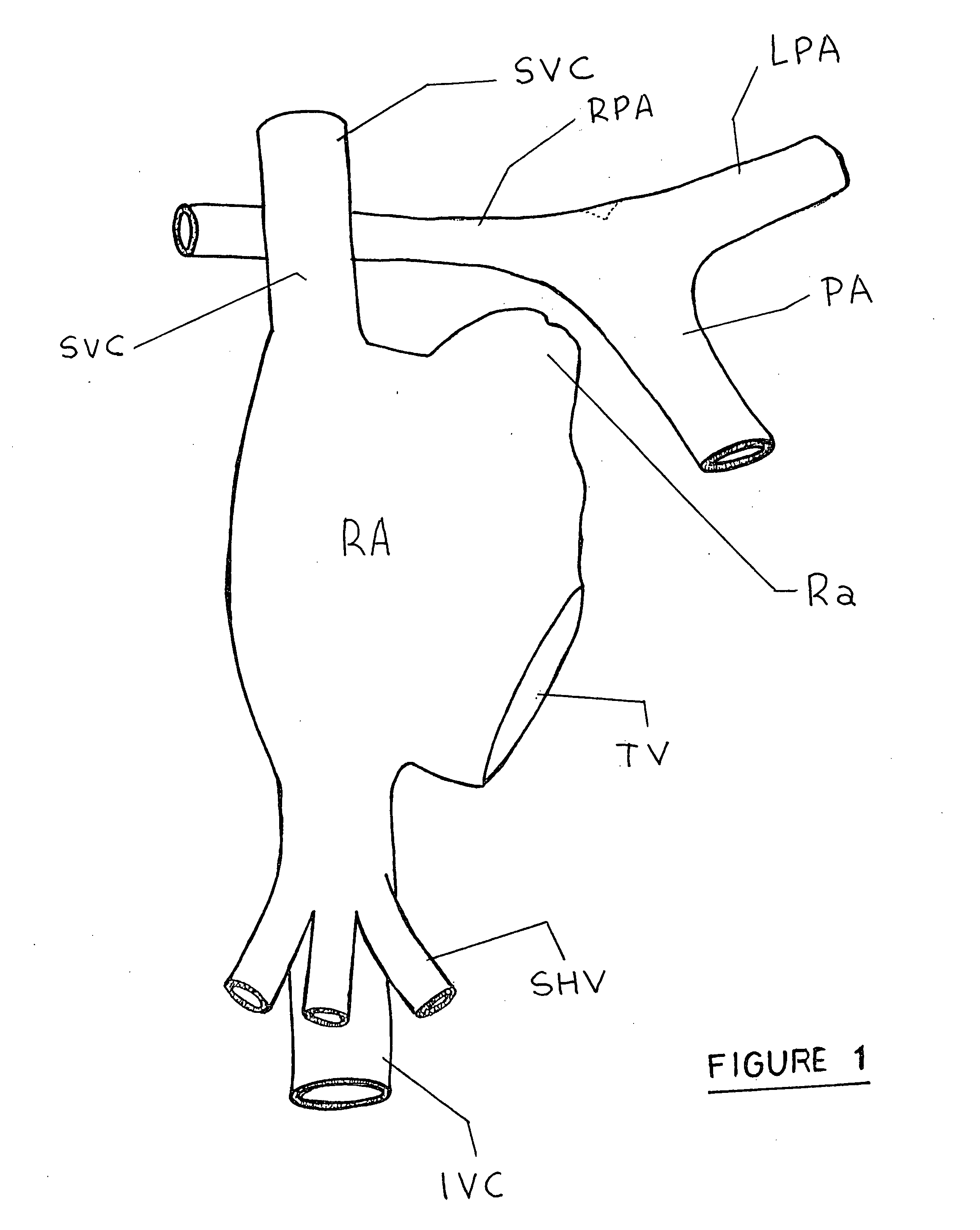 Fenestrated asymmetric intracardiac device for the completion of total cavopulmonary anastomosis through cardiac catheterization