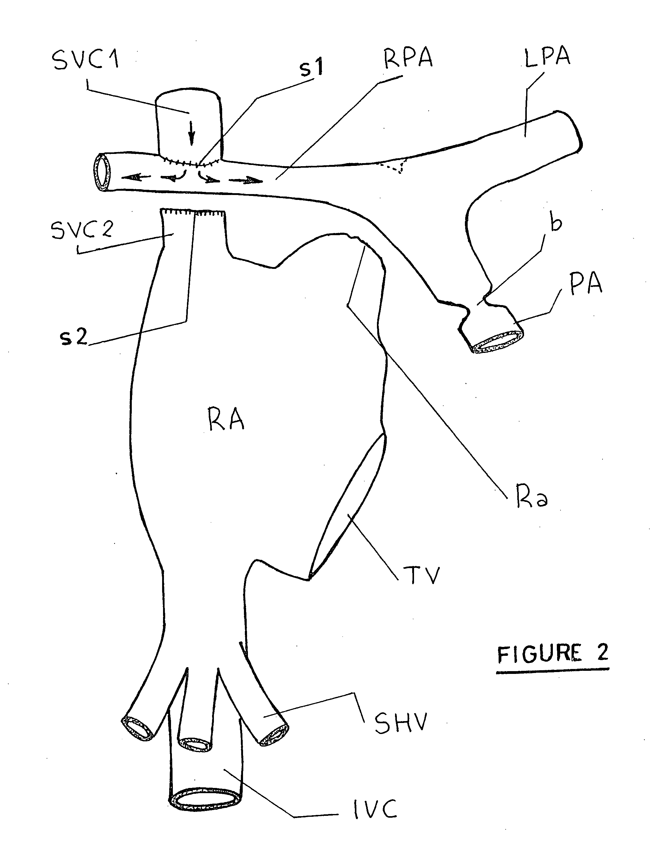 Fenestrated asymmetric intracardiac device for the completion of total cavopulmonary anastomosis through cardiac catheterization