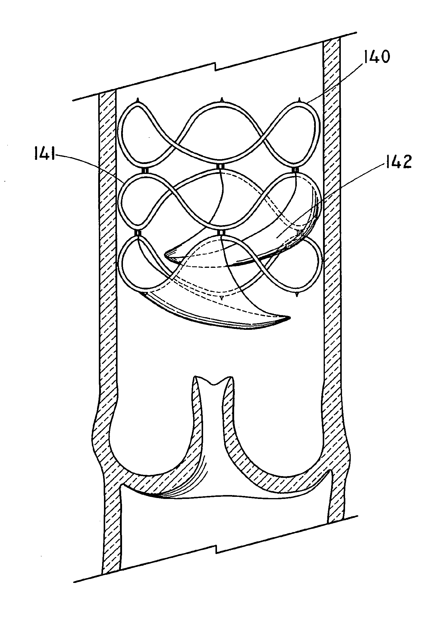 Flow-Deflecting Prosthesis for Treating Venous Disease