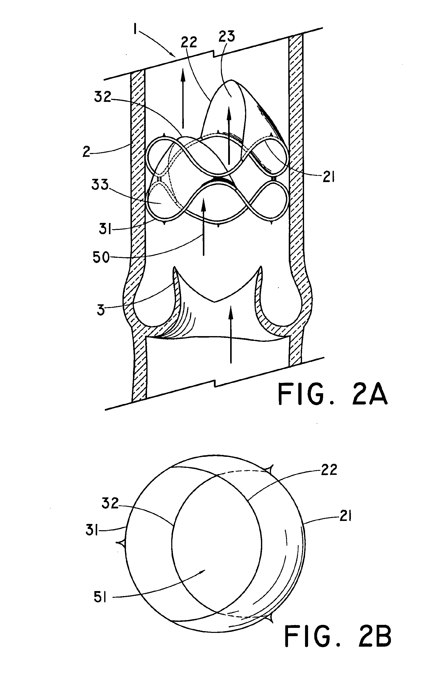 Flow-Deflecting Prosthesis for Treating Venous Disease