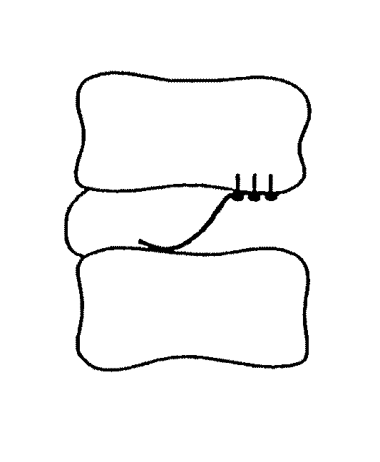 Methods and apparatus for treating disc herniation and preventing the extrusion of interbody bone graft