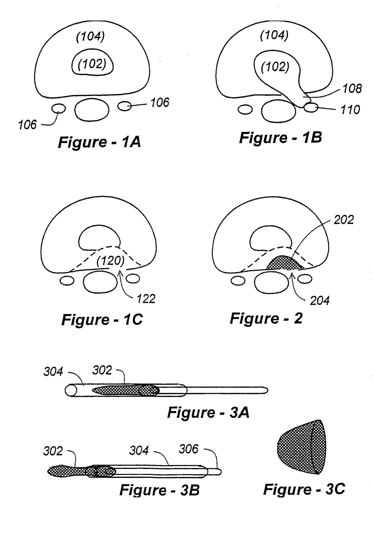 Methods and apparatus for treating disc herniation and preventing the extrusion of interbody bone graft