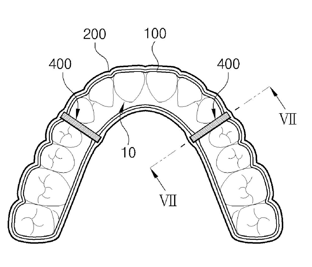 Orthodontic braces