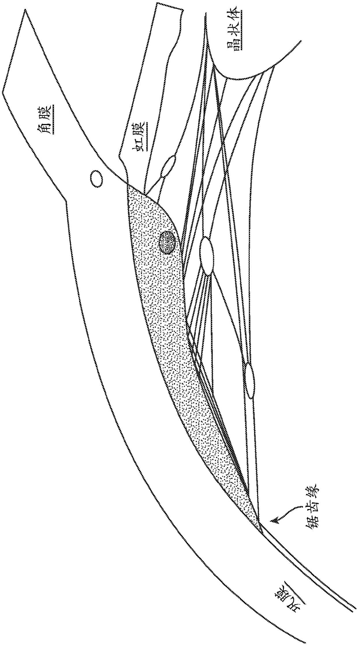 Ultrasound directed cavitational methods and system for ocular treatments