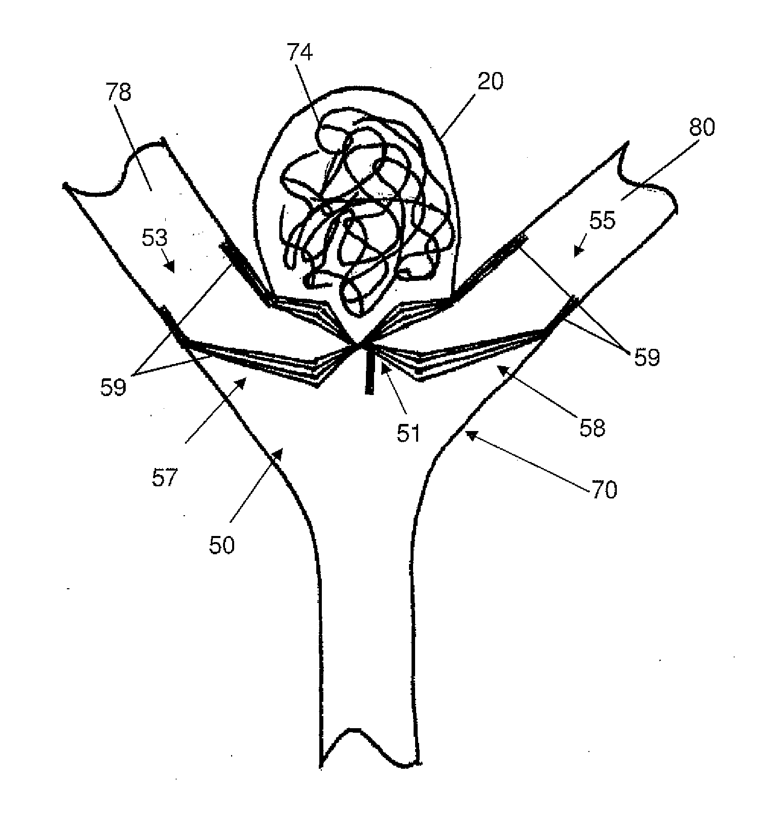 Vascular remodeling device