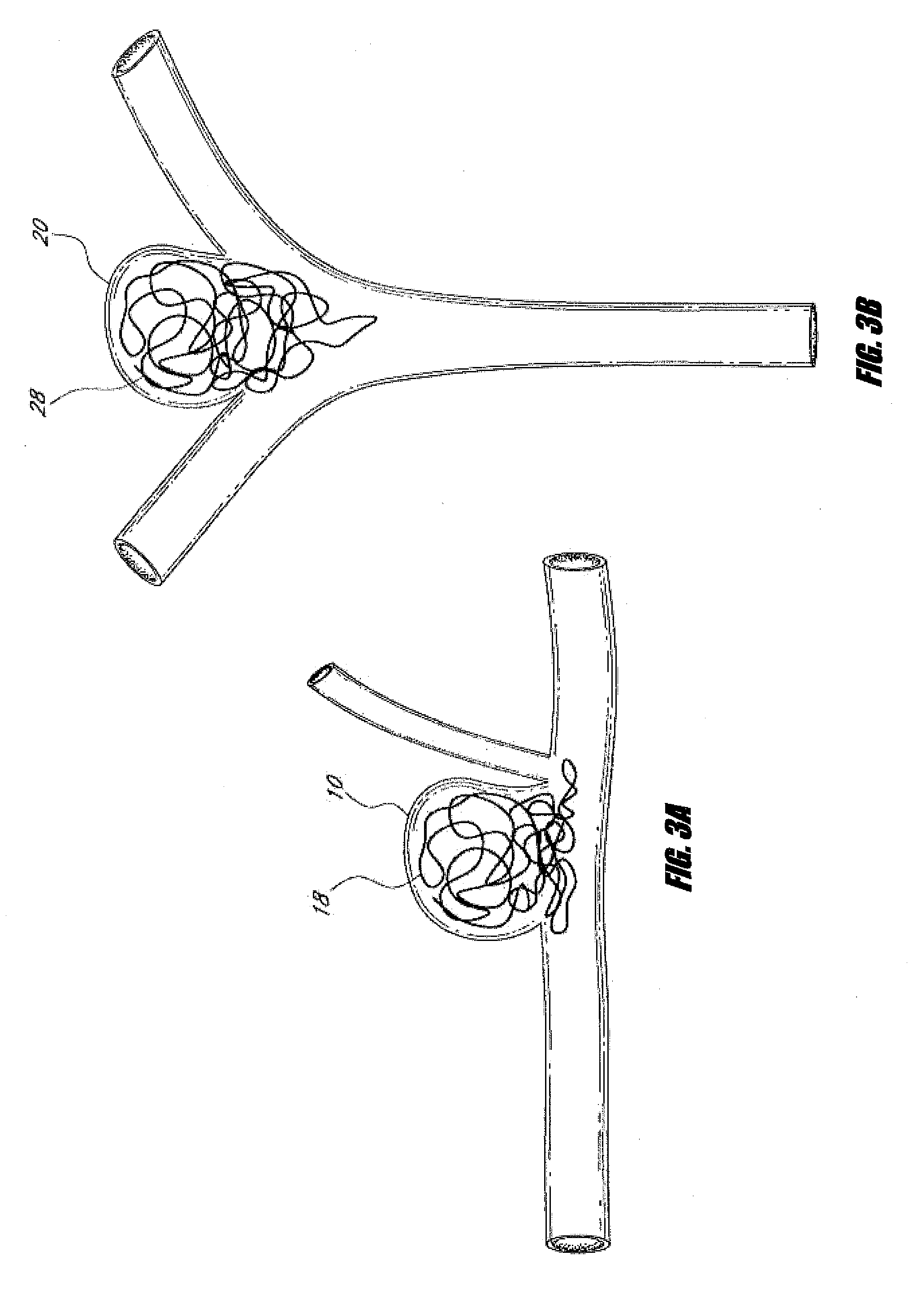 Vascular remodeling device