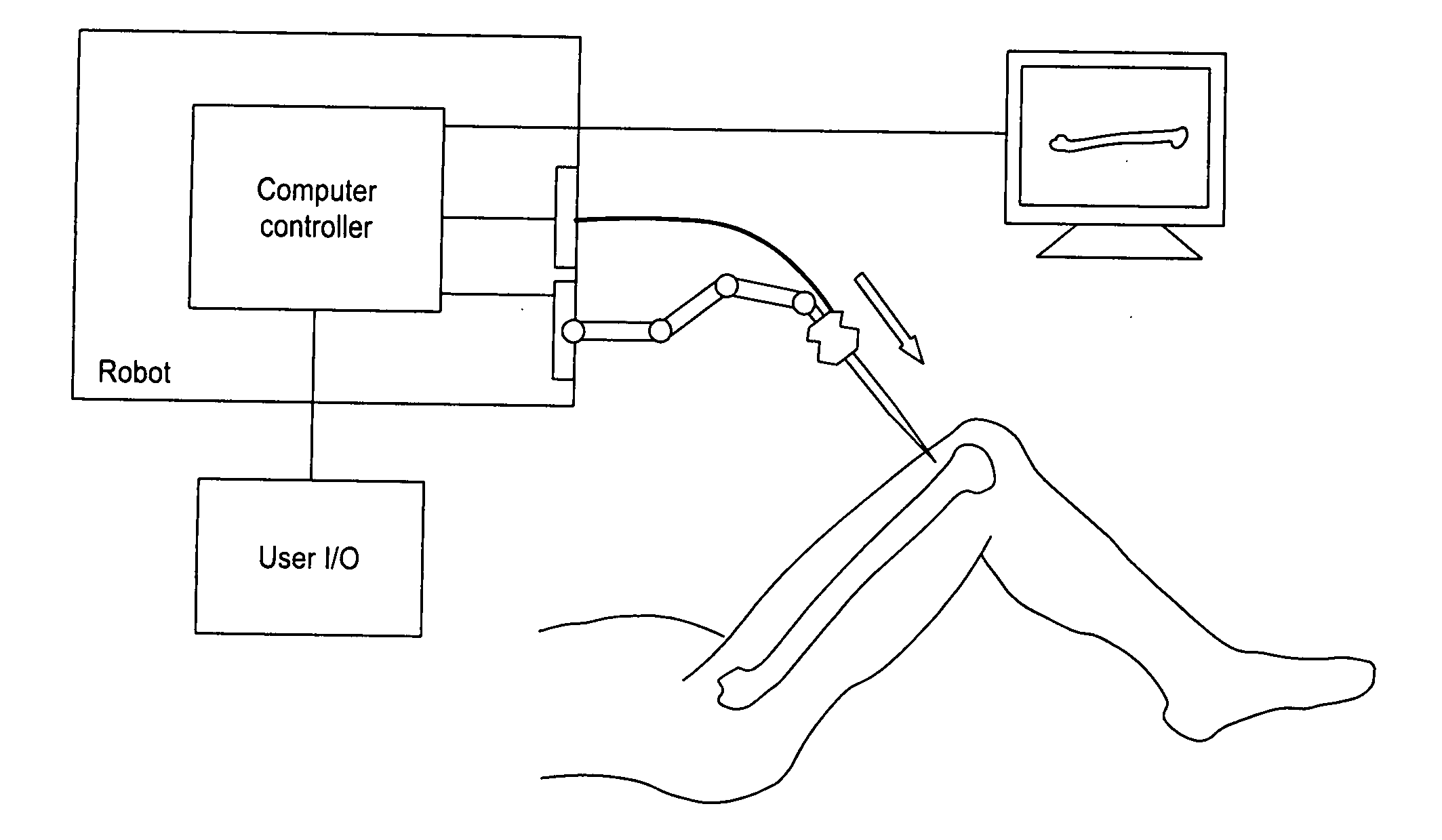 In vivo sensor for detecting bone surface