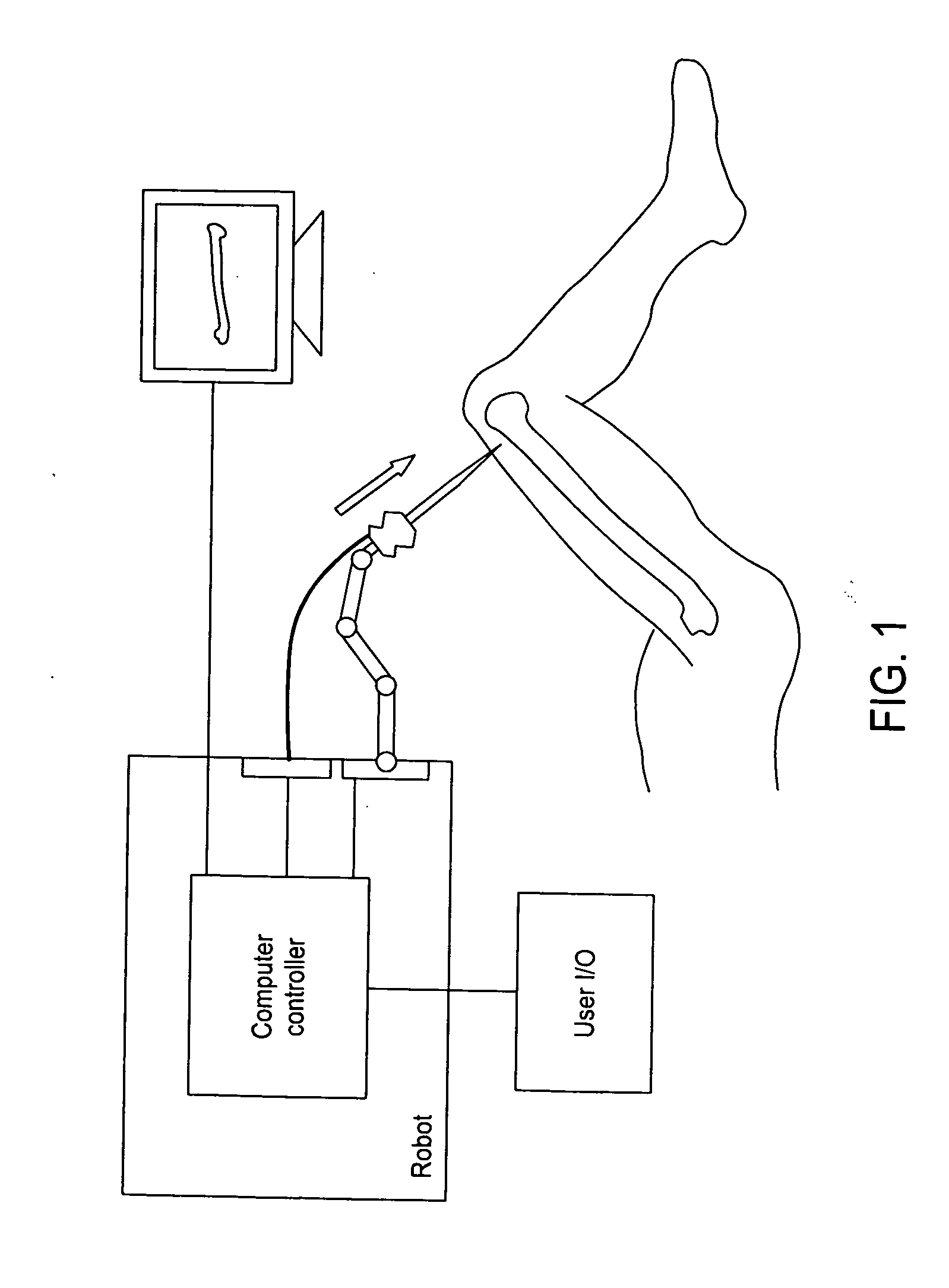 In vivo sensor for detecting bone surface