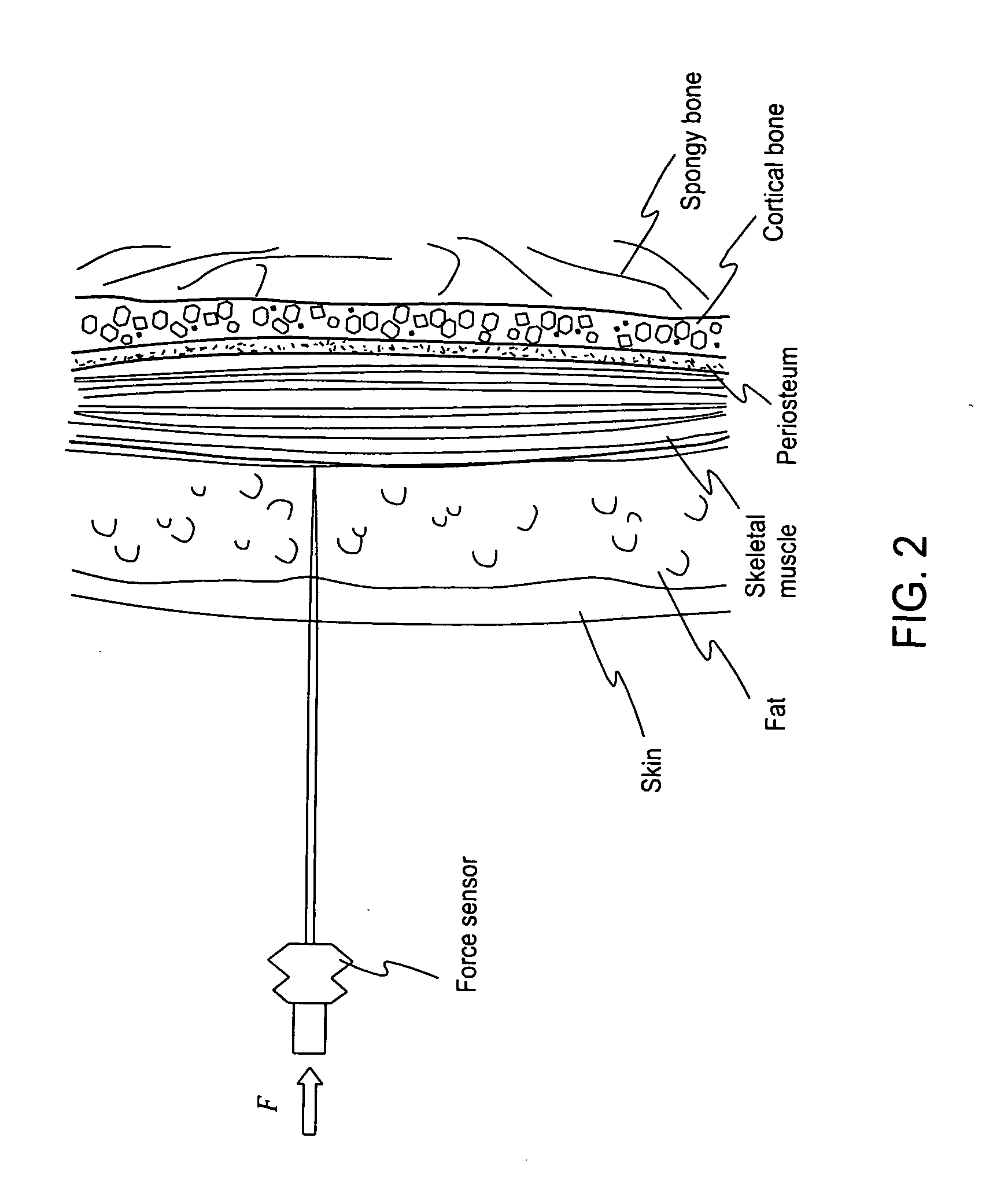 In vivo sensor for detecting bone surface