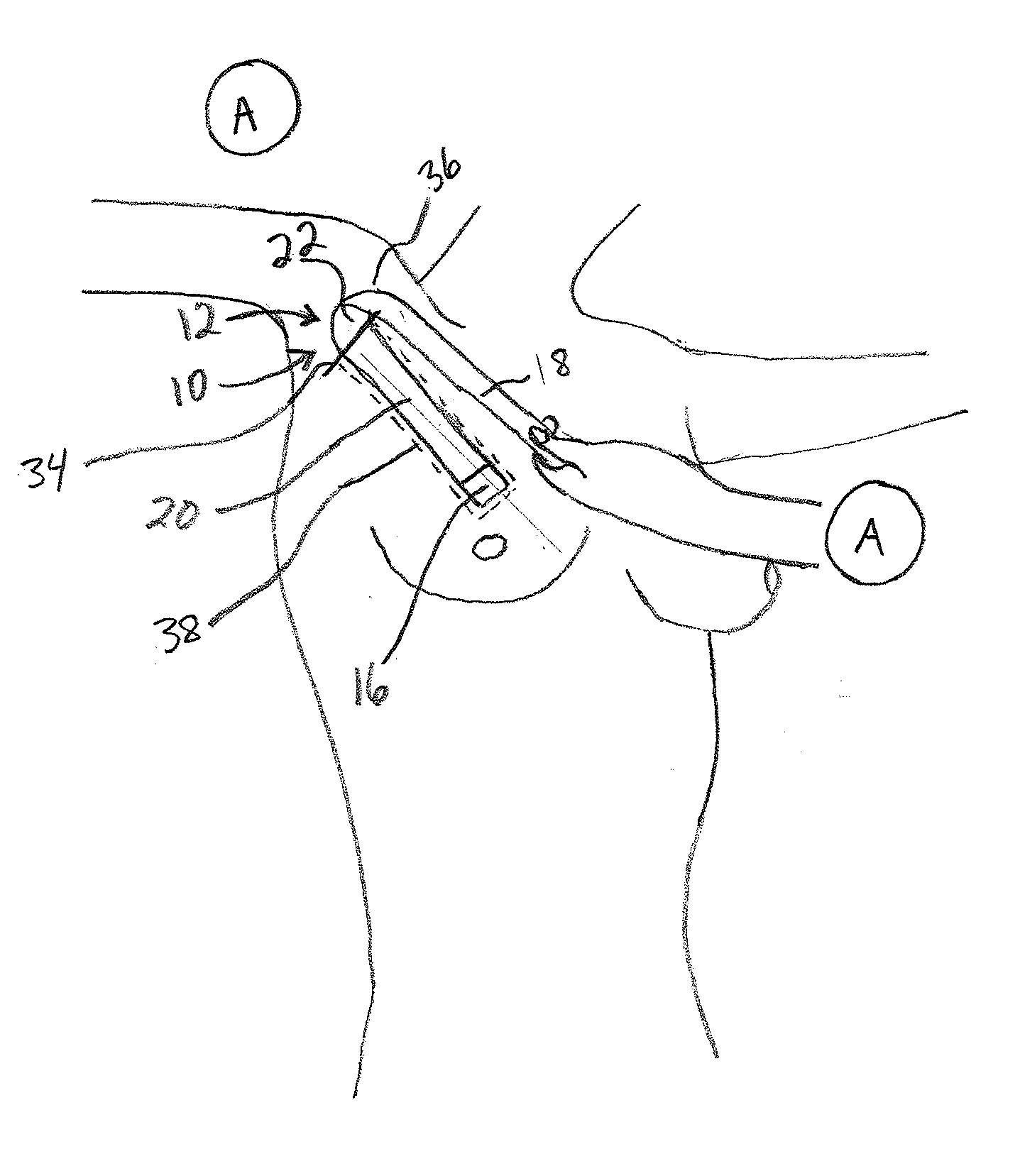 Device for transaxillary breast augmentation and associated method