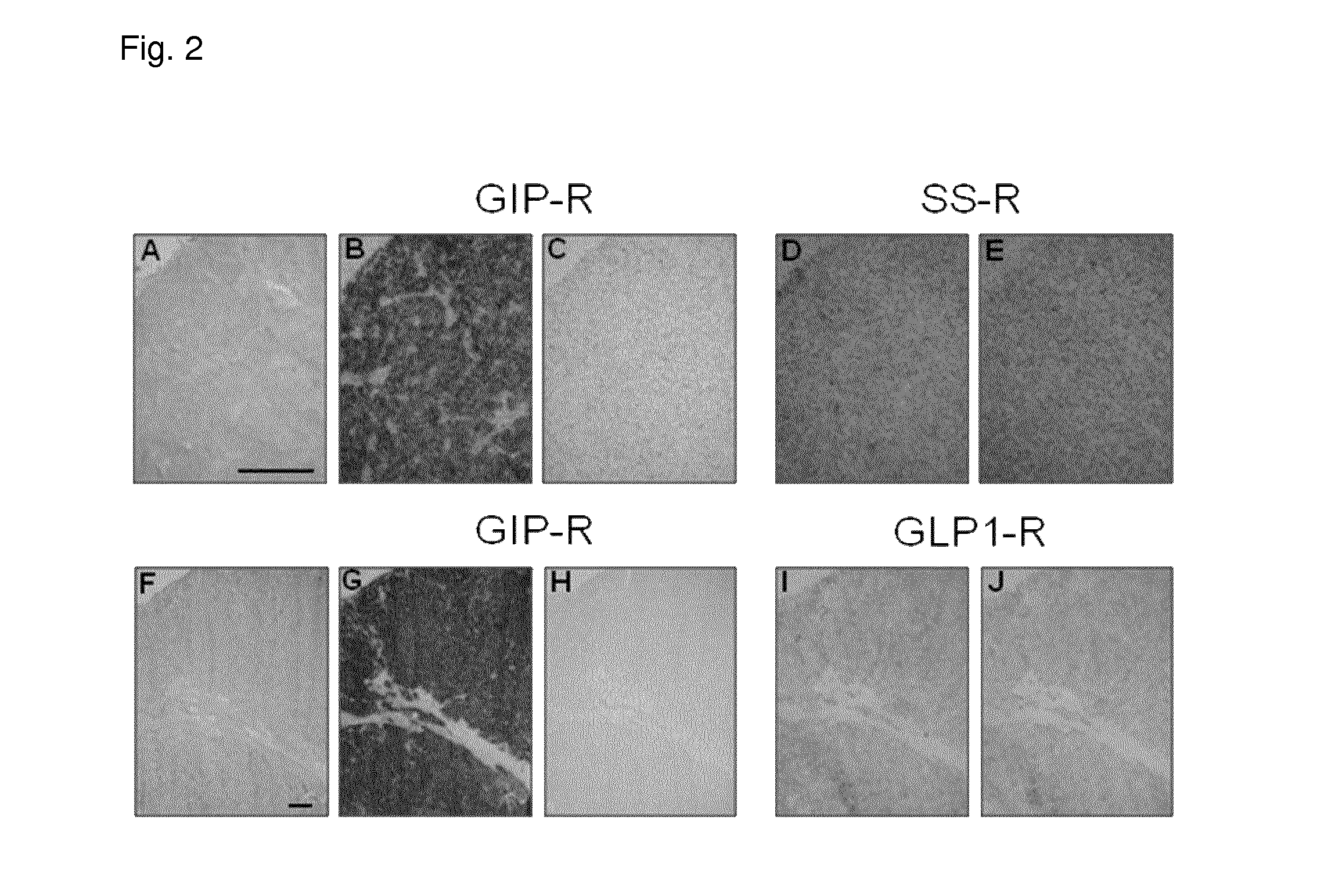 Imaging and Treatment of Neuroendocrine Tumors with Glucose - Dependent Insulinotropic Polypeptide or Analogues or Antagonists Thereof