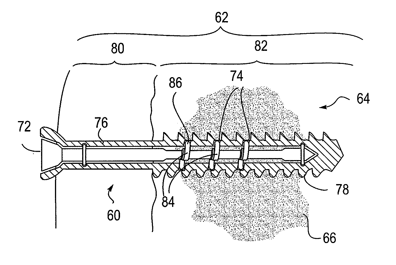 Bone implant and systems that controllably releases silver