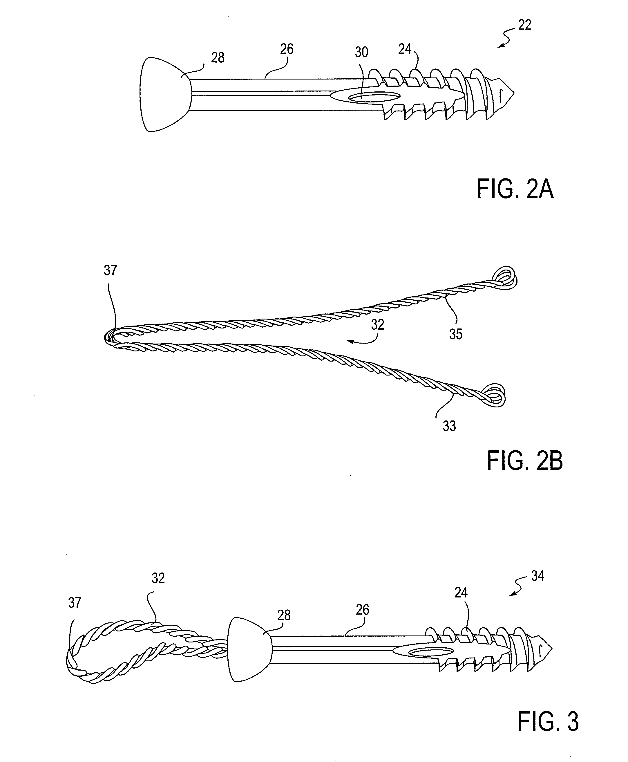 Bone implant and systems that controllably releases silver