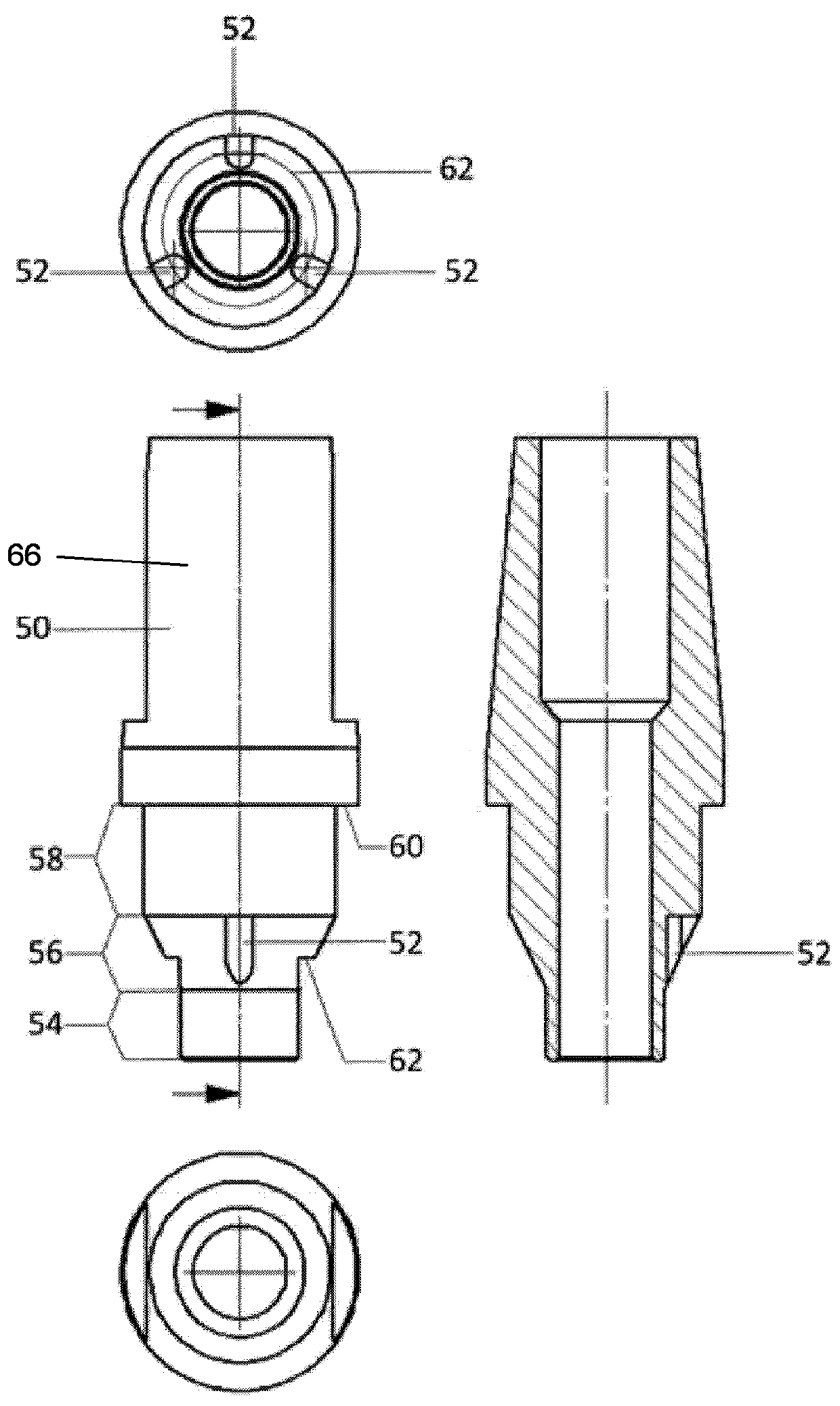 intraosseous single tooth implant