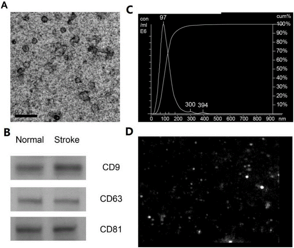 Application of serum exosomes miR-9-3p and miR-124-3p as diagnosis markers of acute cerebral infarction