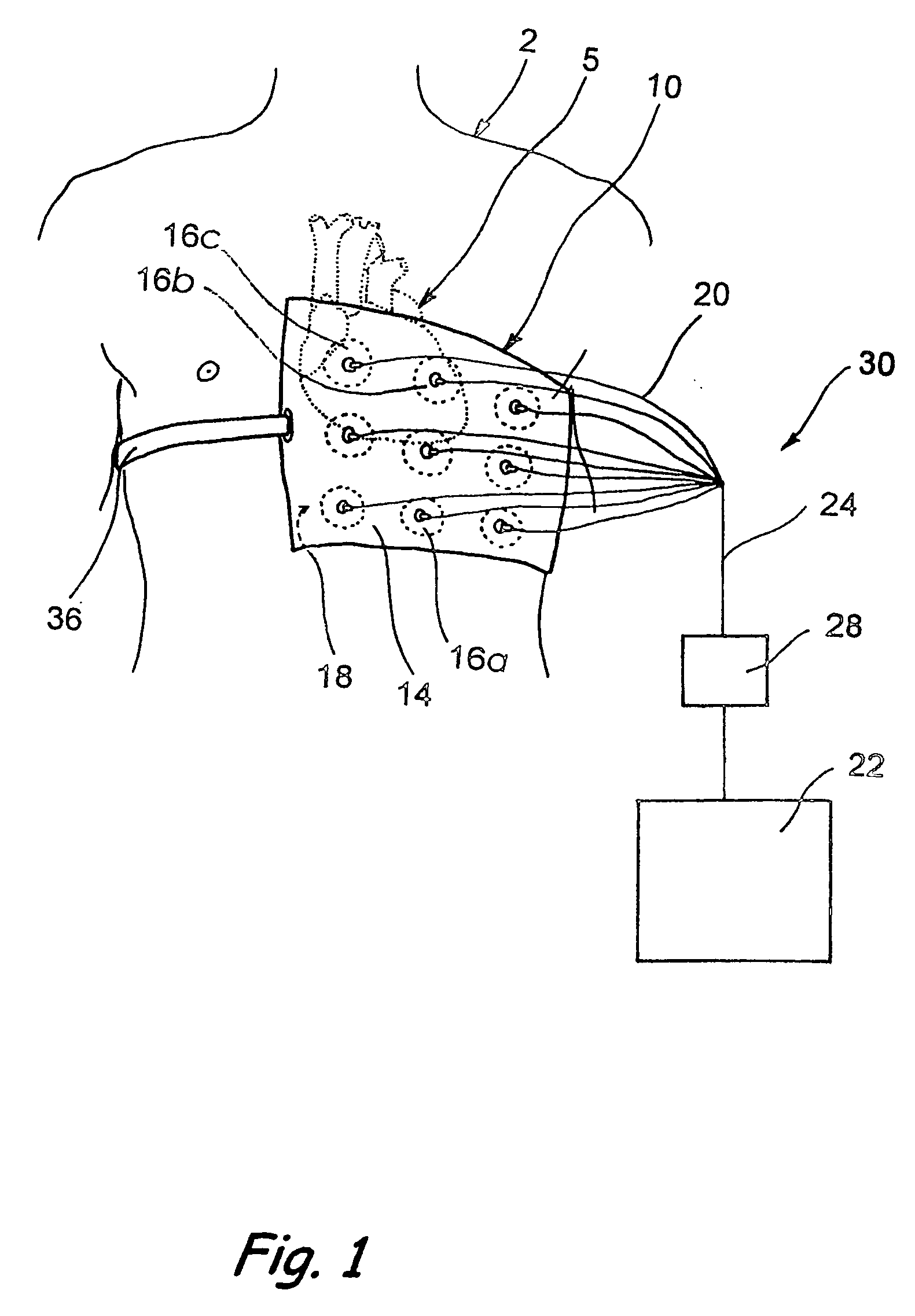 Ultrasound devices and methods for treating ischemia and other cardiovascular disorders