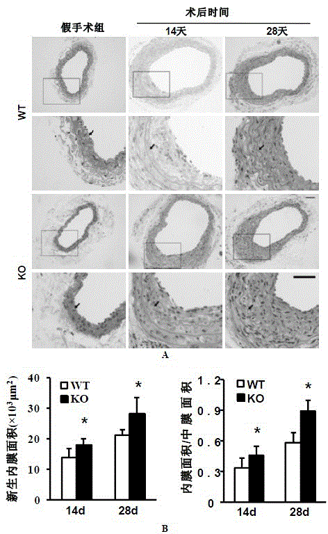 Function and application of interferon regulatory factor 4 (IRF4) in scaffold and endarterectomy restenosis