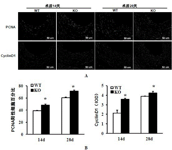 Function and application of interferon regulatory factor 4 (IRF4) in scaffold and endarterectomy restenosis