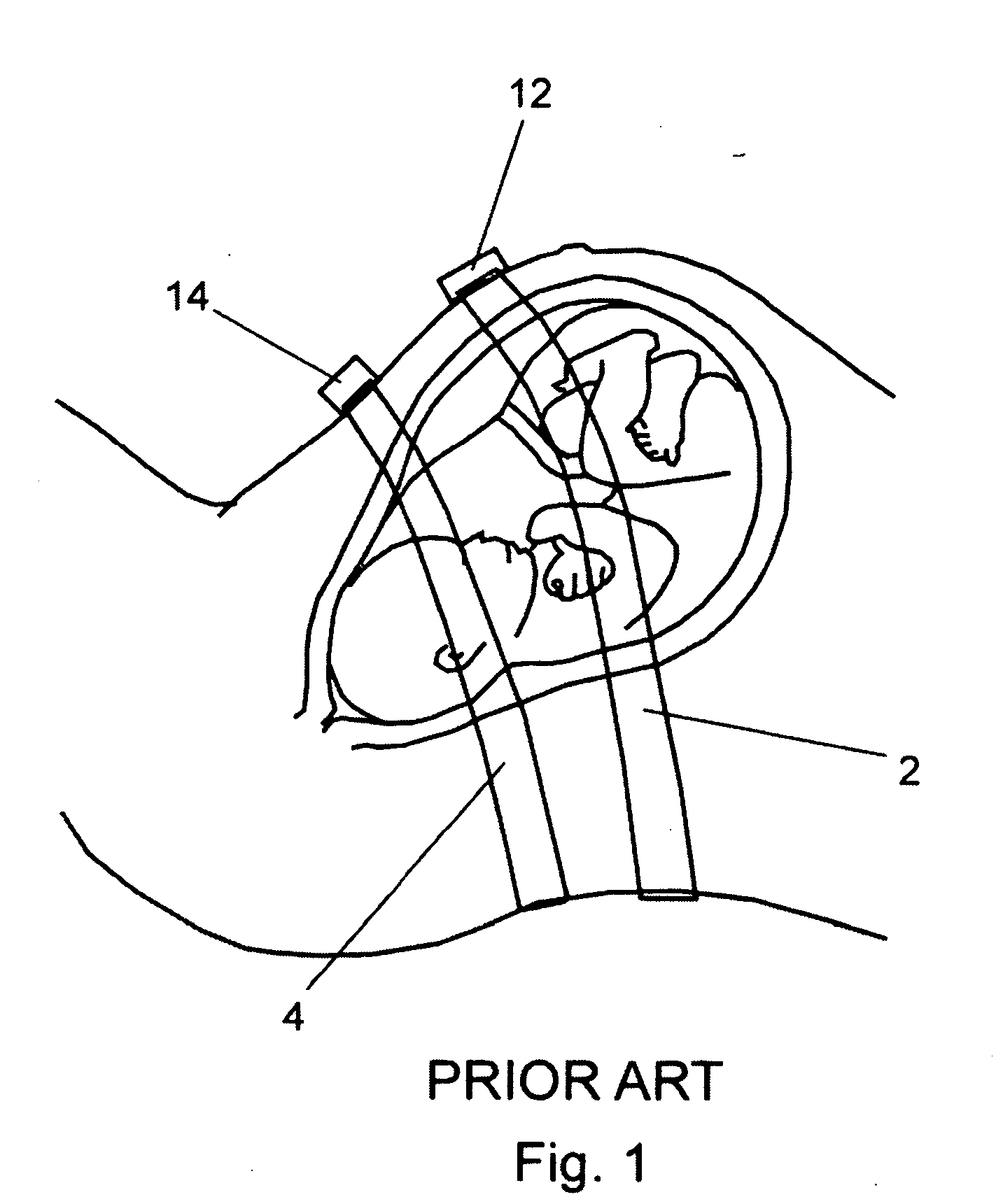 System, method, and kit for positioning a monitor transducer on a patient