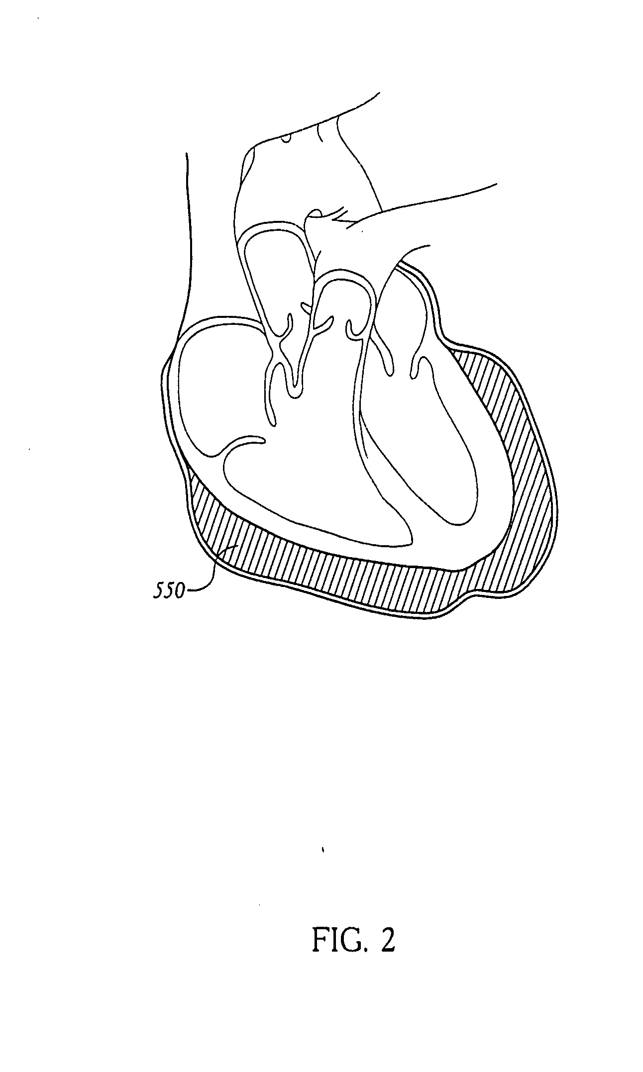 Pericardial inserts