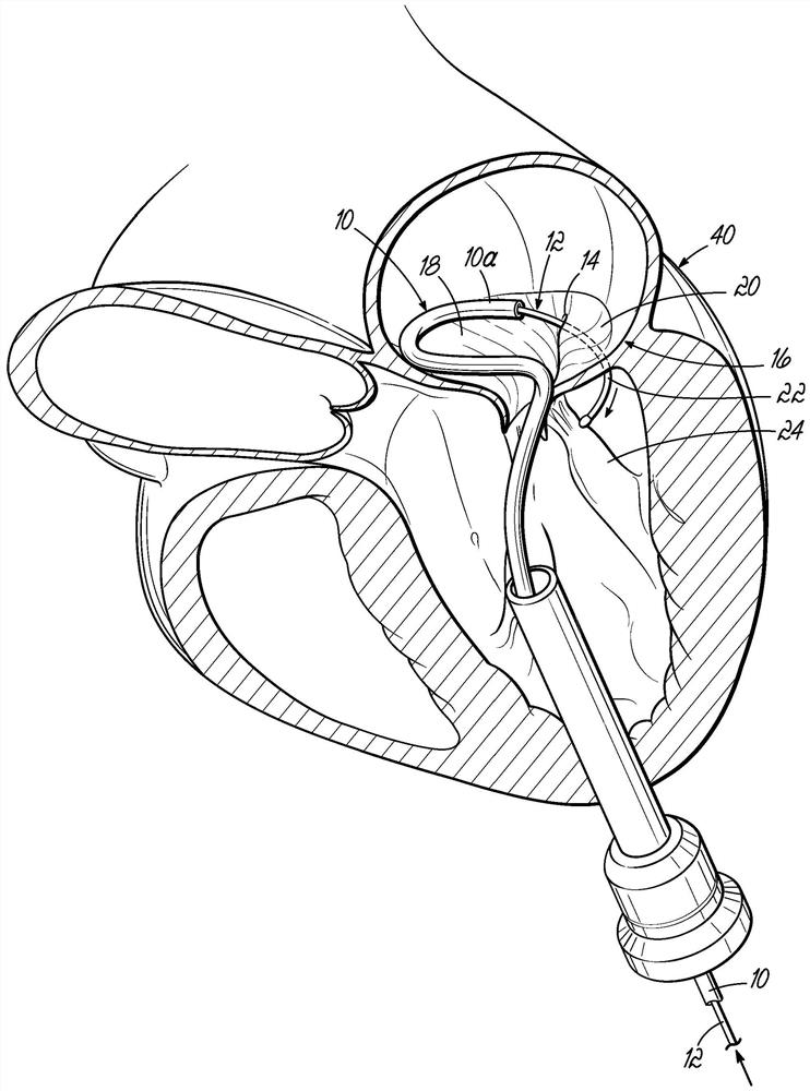 Heart valve replacement device and method