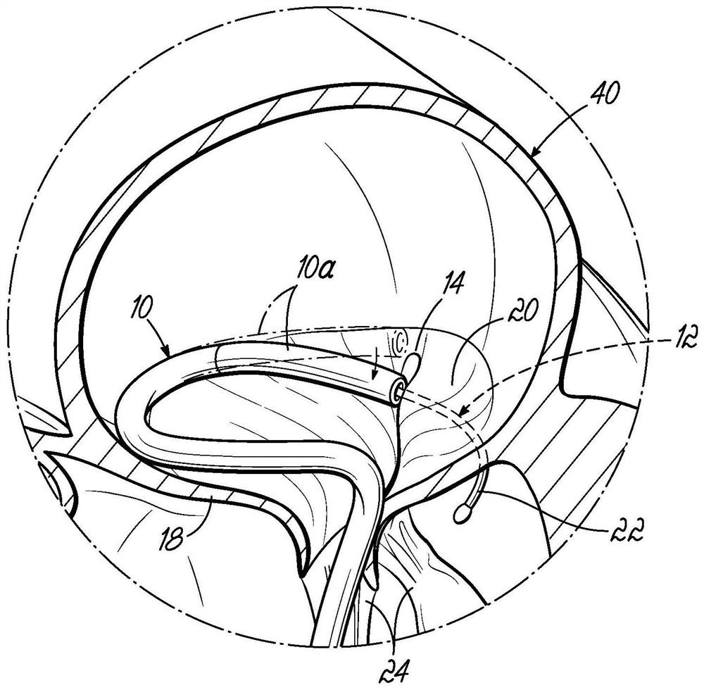 Heart valve replacement device and method